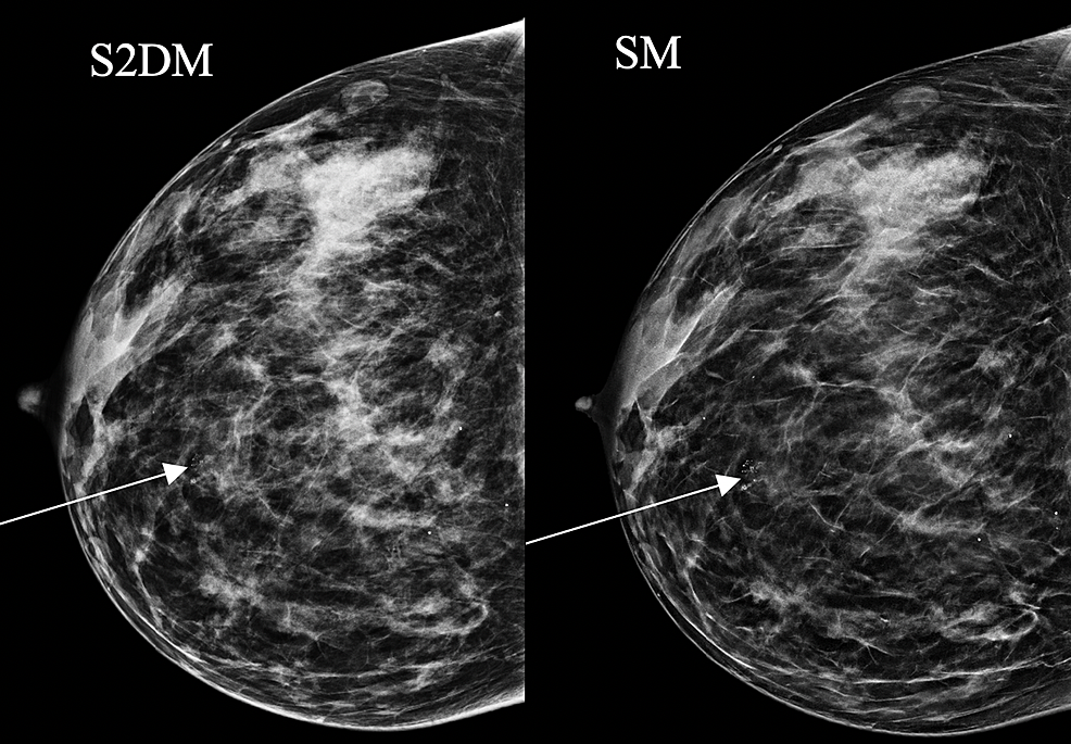 Cureus, Could Breast Tomosynthesis With Synthetic View Mammography Aid  Standard Two-Dimensional Mammography in Evaluation at Symptomatic Triple  Assessment Breast Clinics?