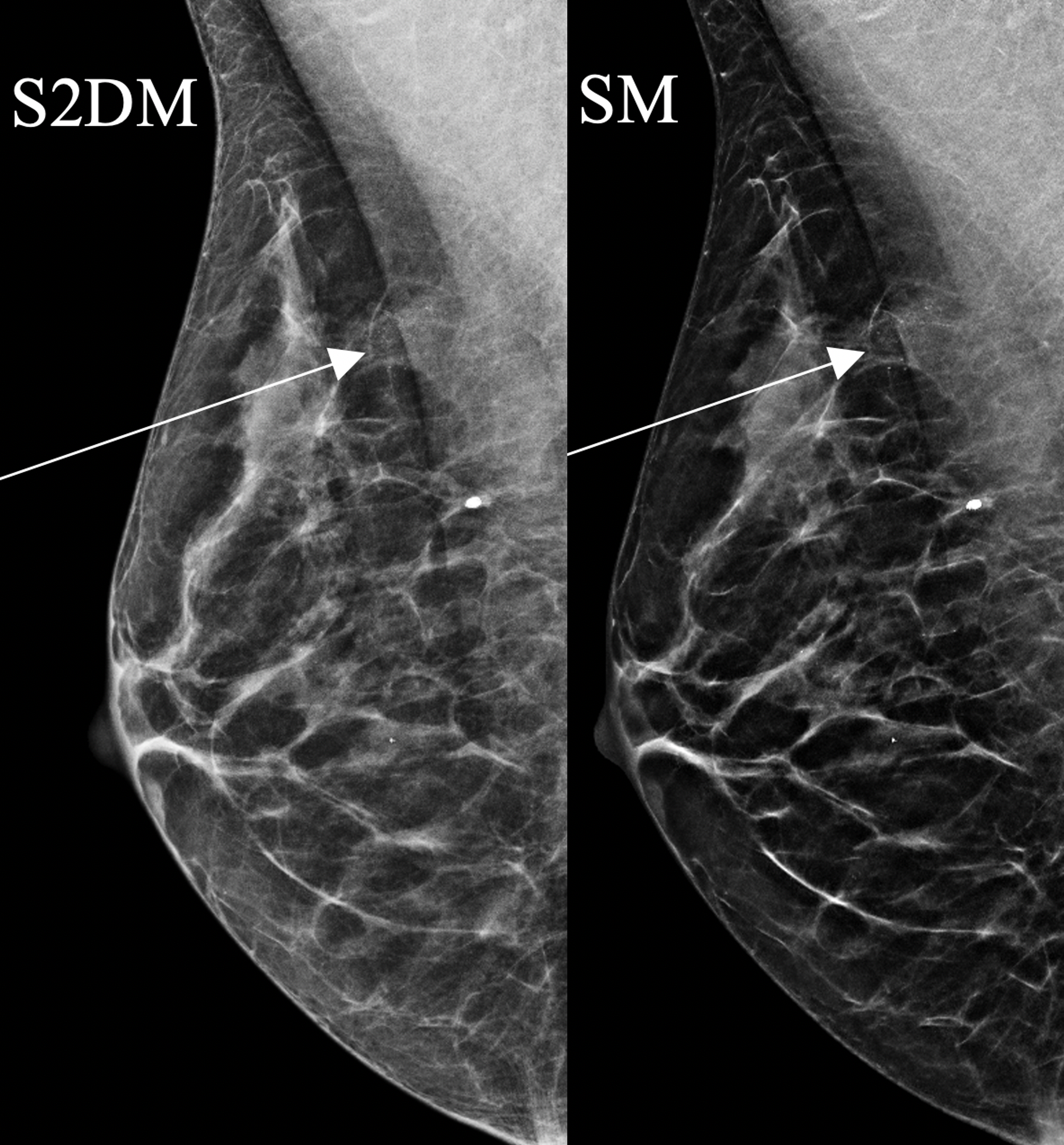 breast cancer digital mammogram
