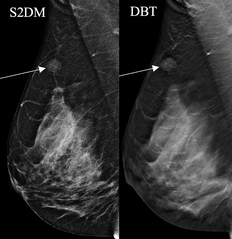 Cureus | Could Breast Tomosynthesis With Synthetic View Mammography Aid ...