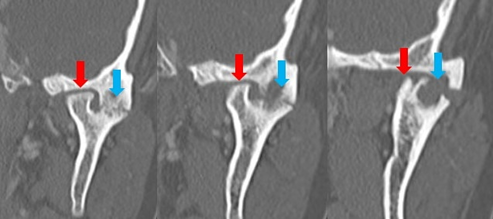 CT-images-of-the-left-TMJ-in-coronal-view.