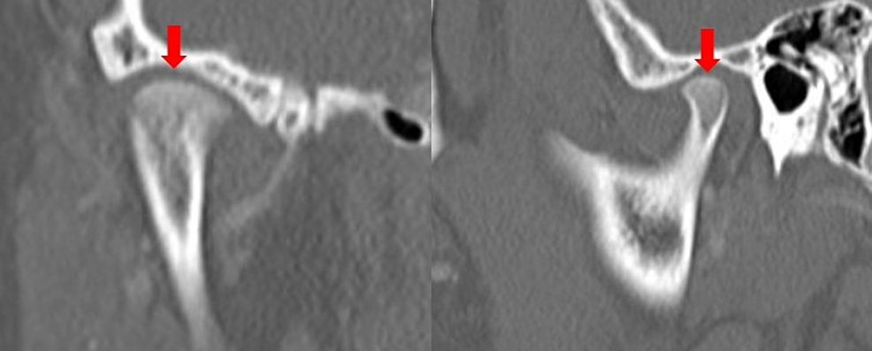 CT-images-of-normal-right-TMJ-shown-in-(A)-coronal-view-and-(b)-sagittal-view.