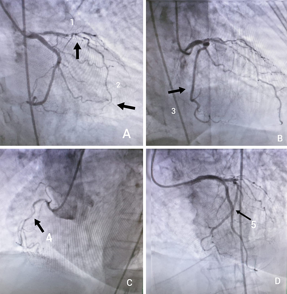 Cureus Acute Inferior STElevation Myocardial Infarction Due to