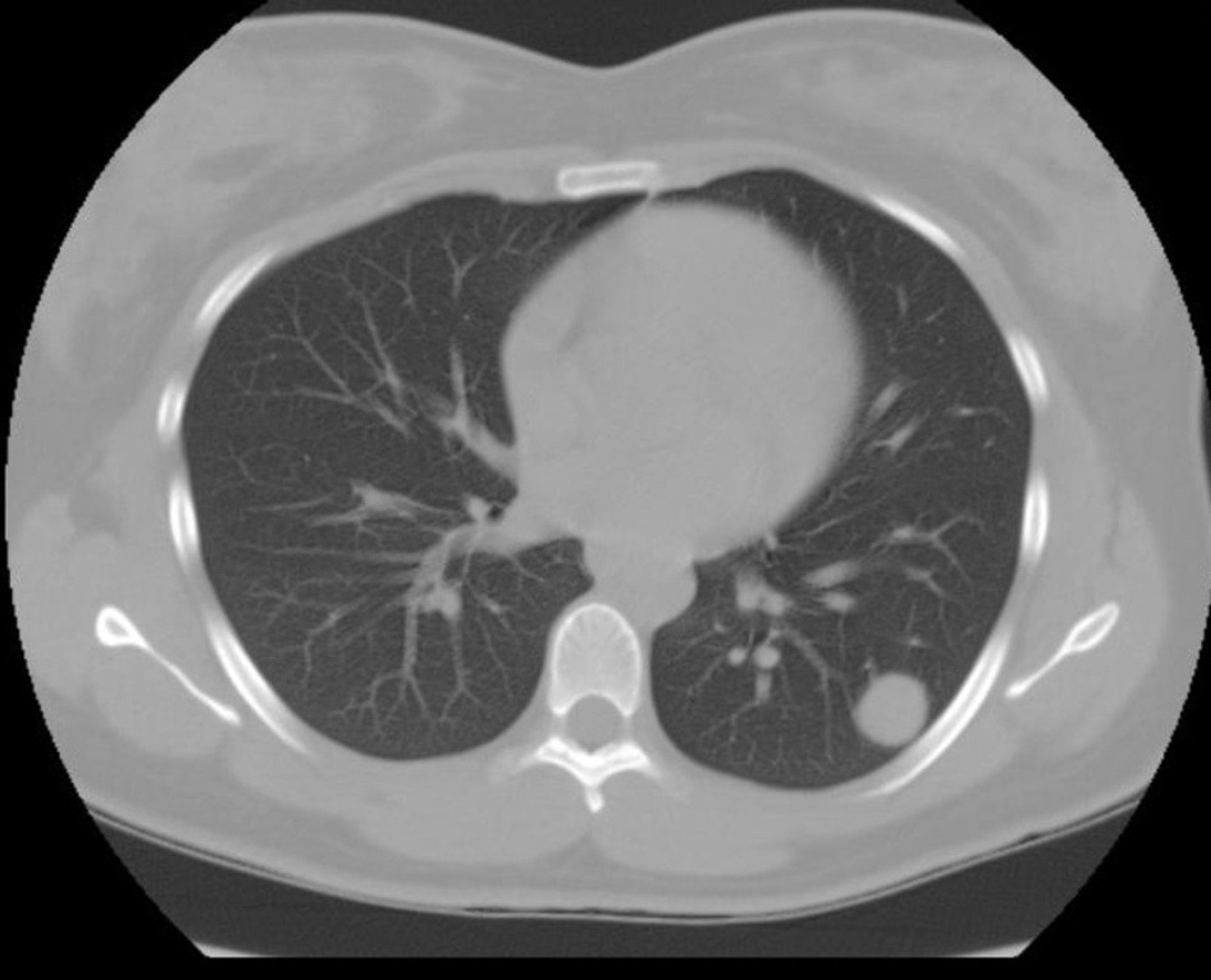 Cureus Pulmonary Sclerosing Pneumocytoma An Essential Differential