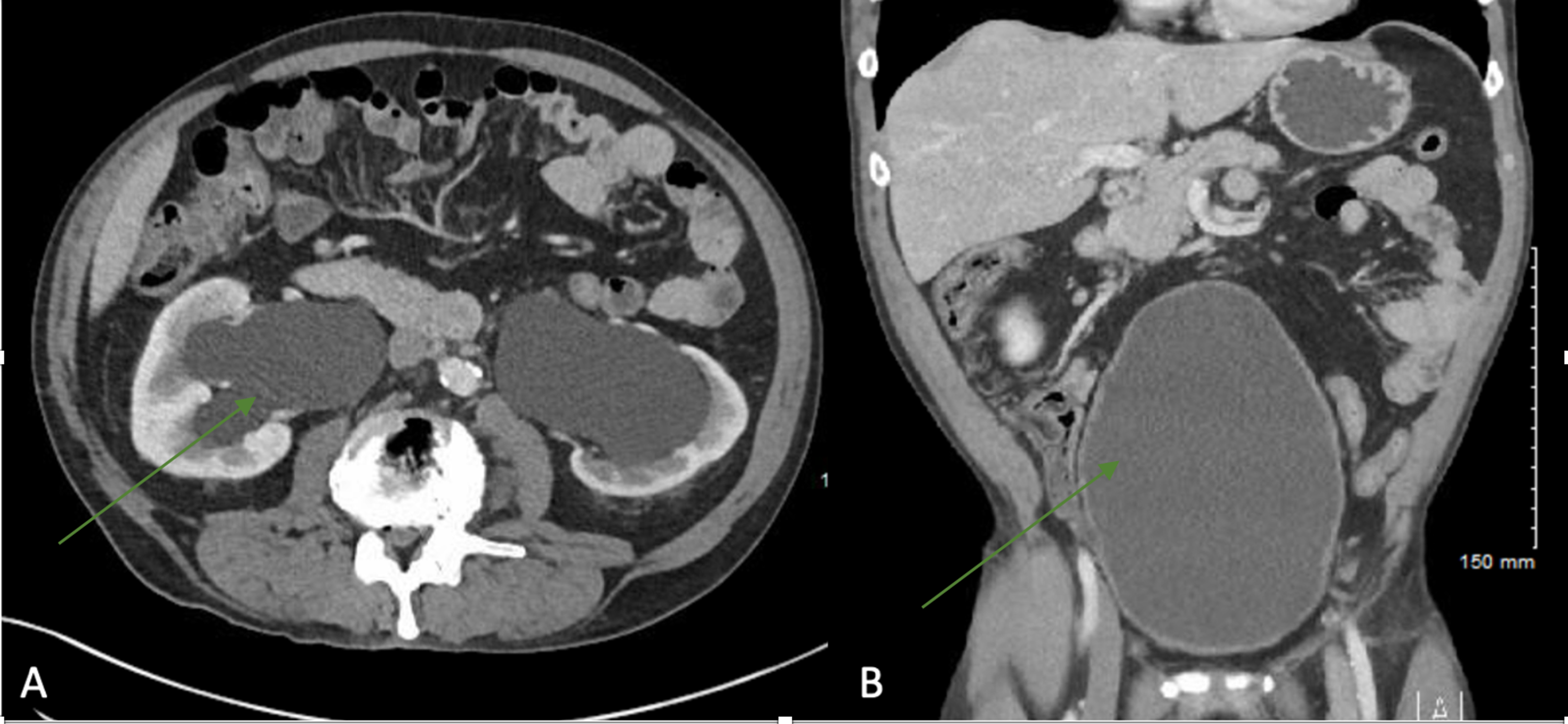 Cureus Polycythemia in a Patient With Atonic Bladder and Hydronephrosis