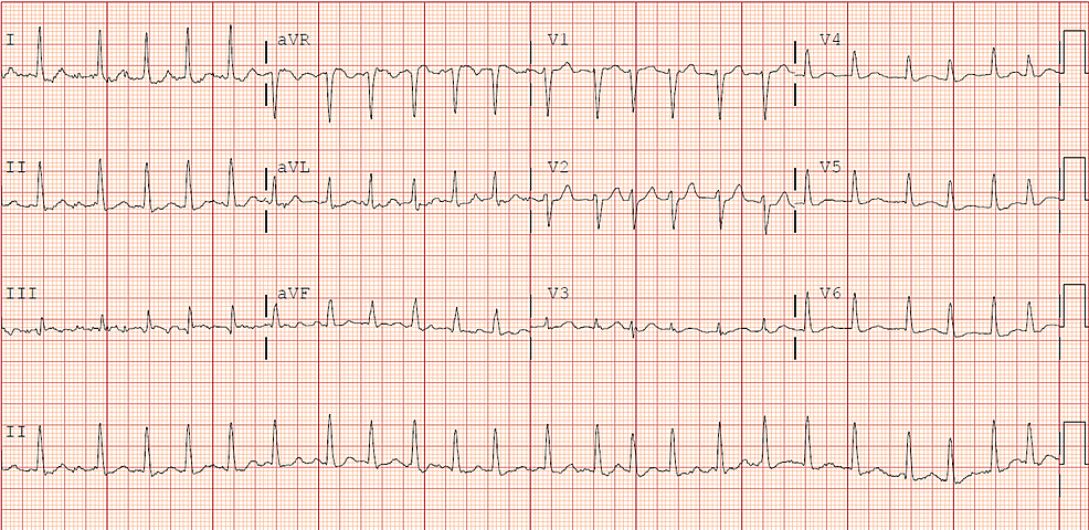 Cureus | Atrial Fibrillation as an Initial Presentation of Apathetic ...