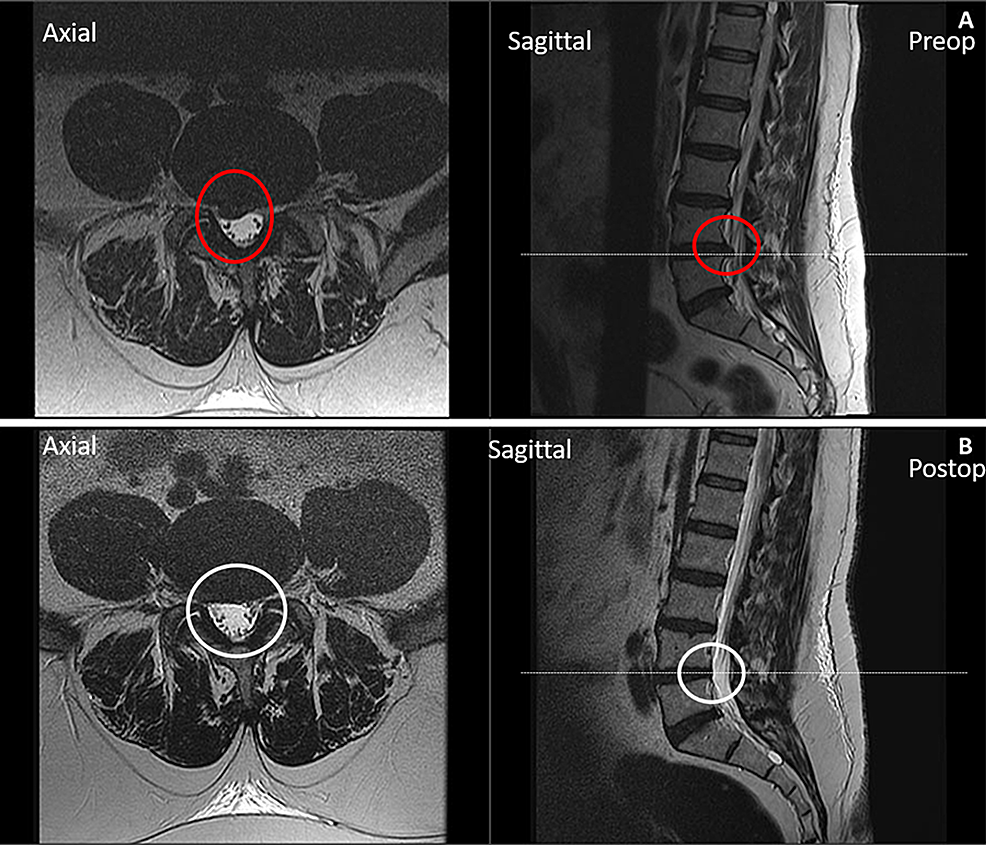 Magnetic-resonance-imaging-(MRI)-of-the-lumbar-spine-