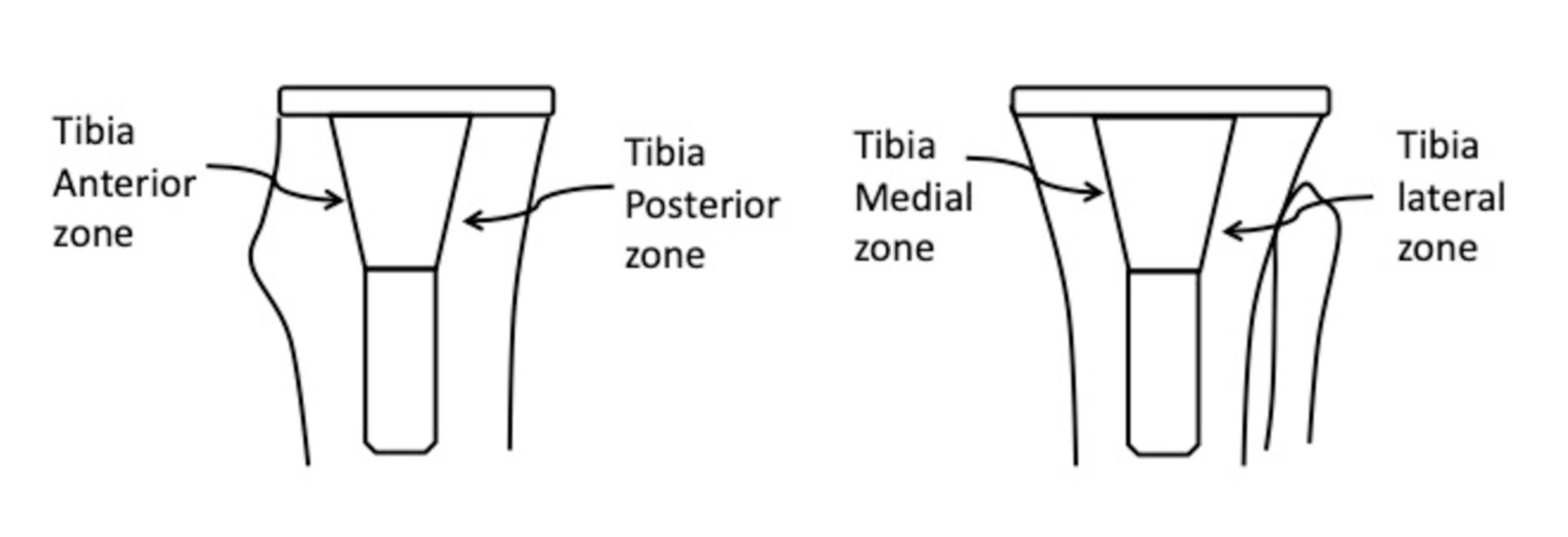 Cureus Metaphyseal Sleeve Failure in Revision Total Knee Arthroplasty