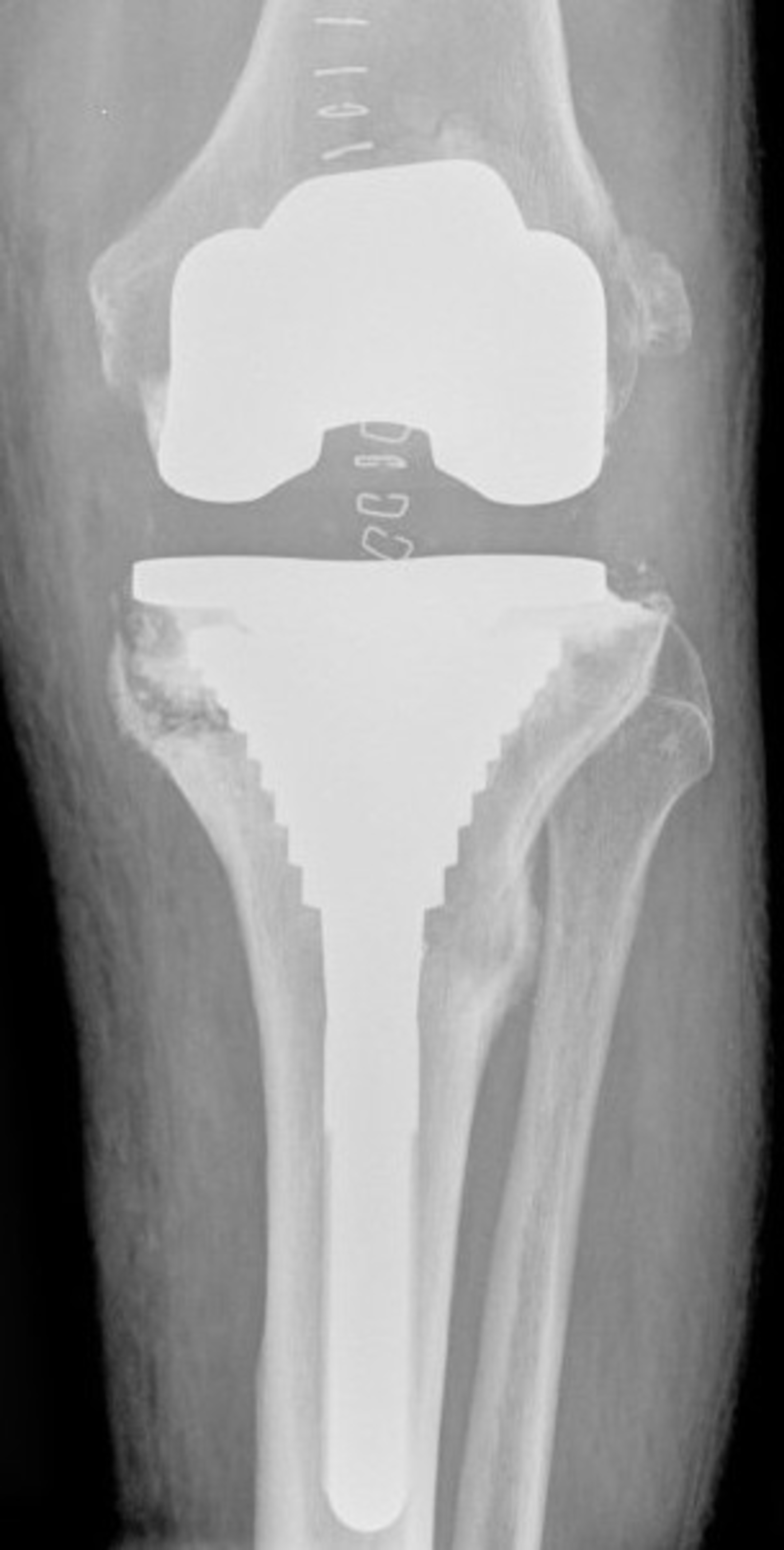 Cureus Metaphyseal Sleeve Failure in Revision Total Knee Arthroplasty