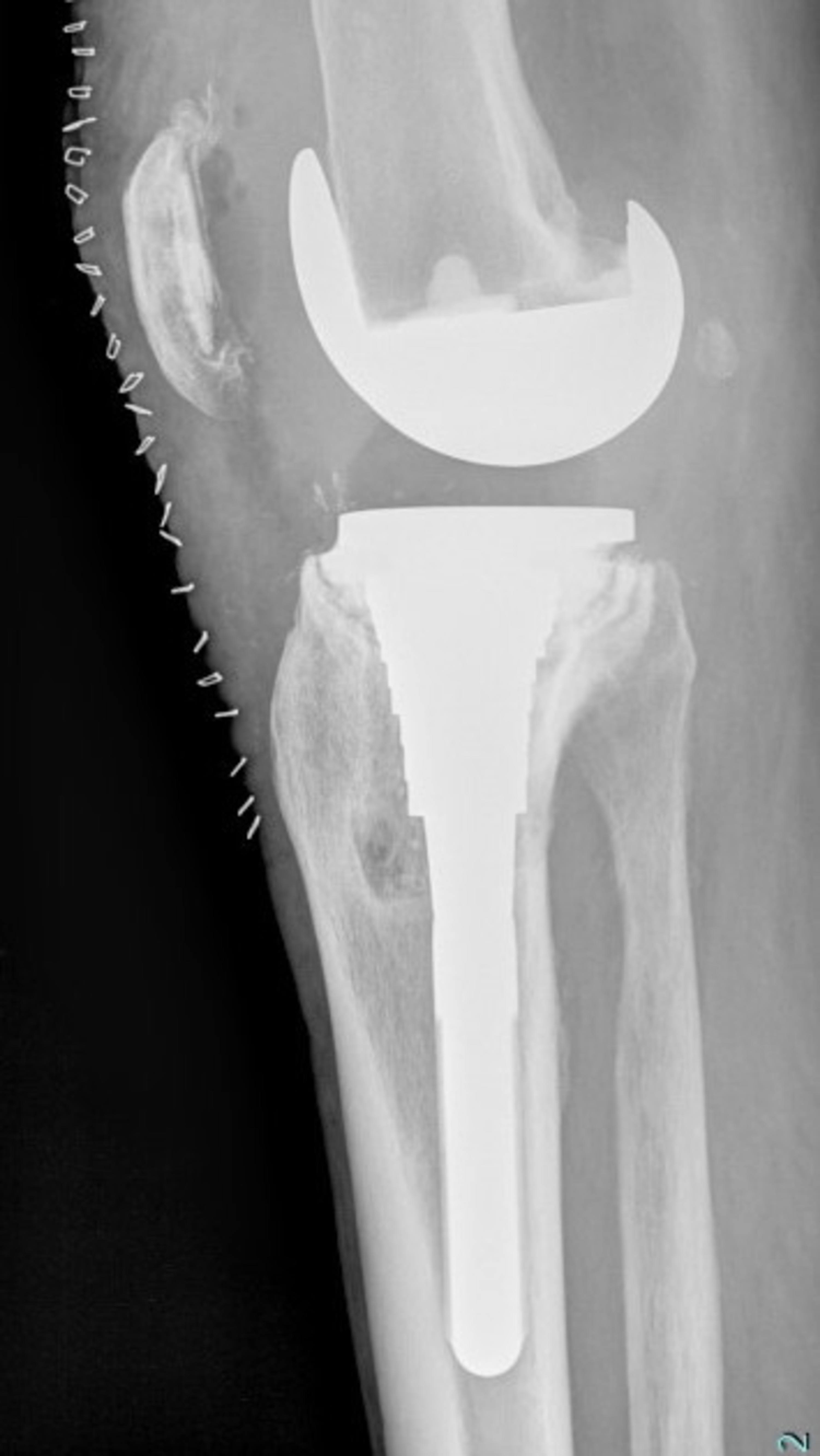 Cureus Metaphyseal Sleeve Failure in Revision Total Knee Arthroplasty
