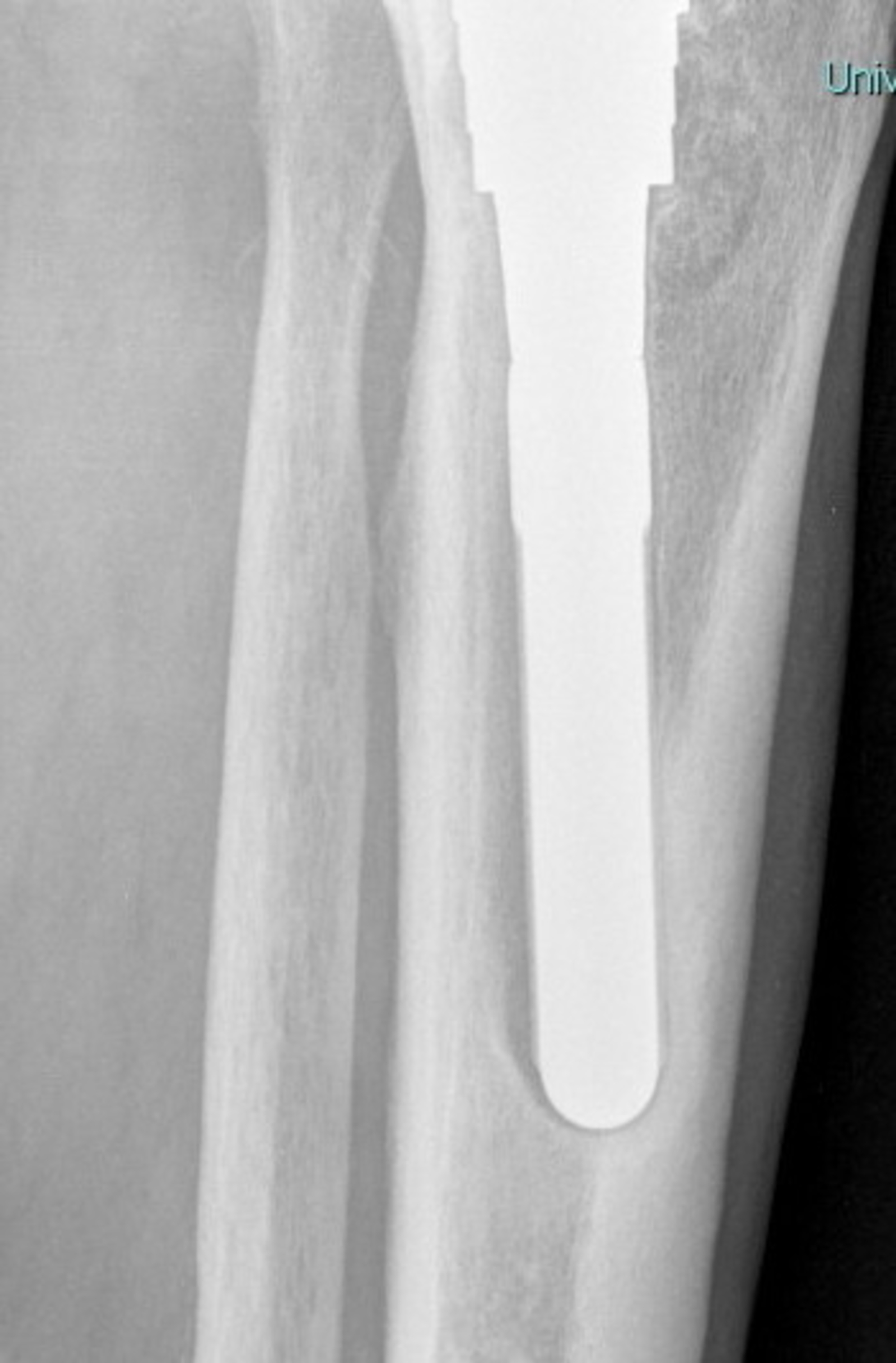 Cureus Metaphyseal Sleeve Failure in Revision Total Knee Arthroplasty