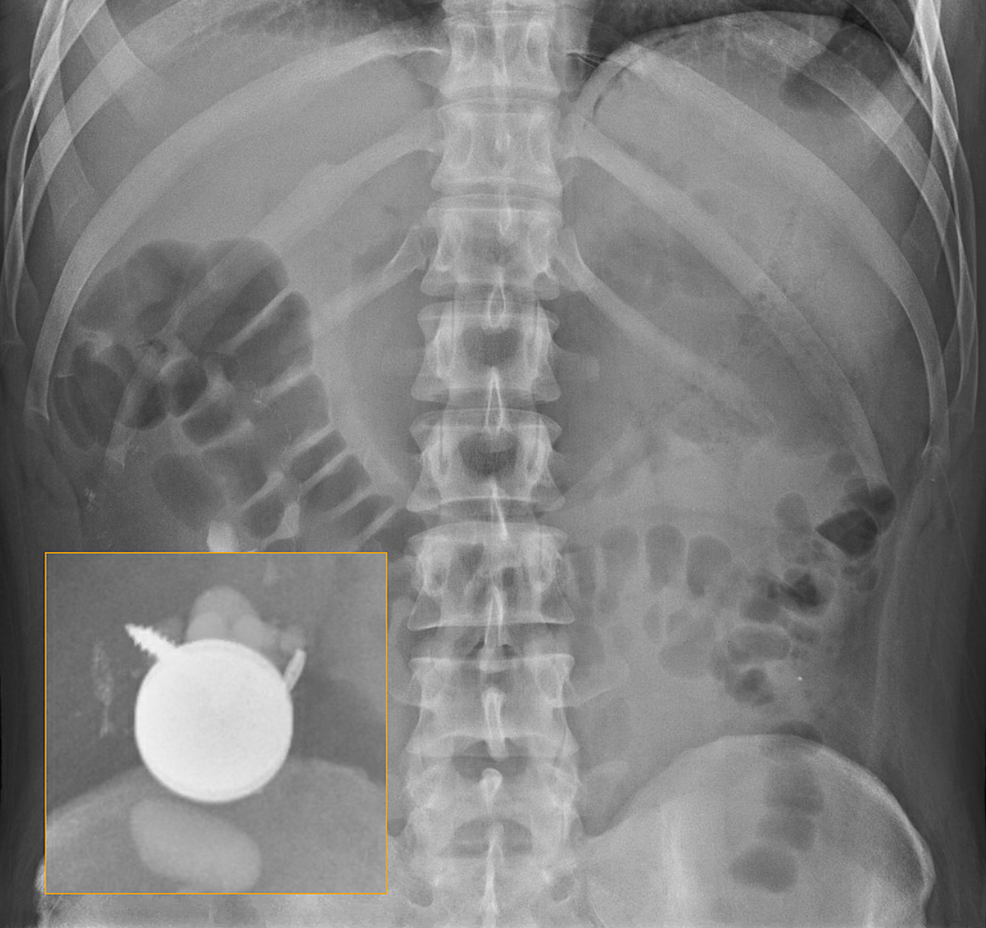 Cureus | Pica in a Patient With Decompensated Schizophrenia