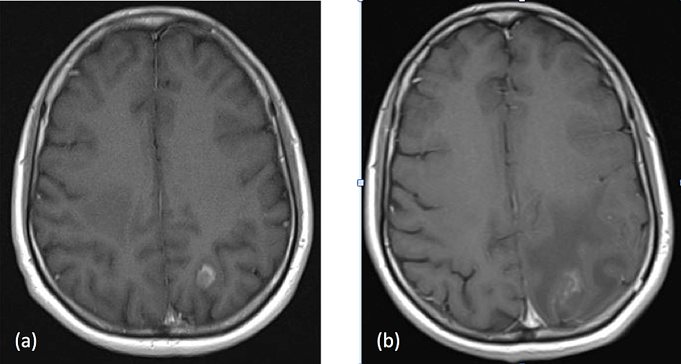 Cureus Radiation Necrosis A Growing Problem in a Case of Brain