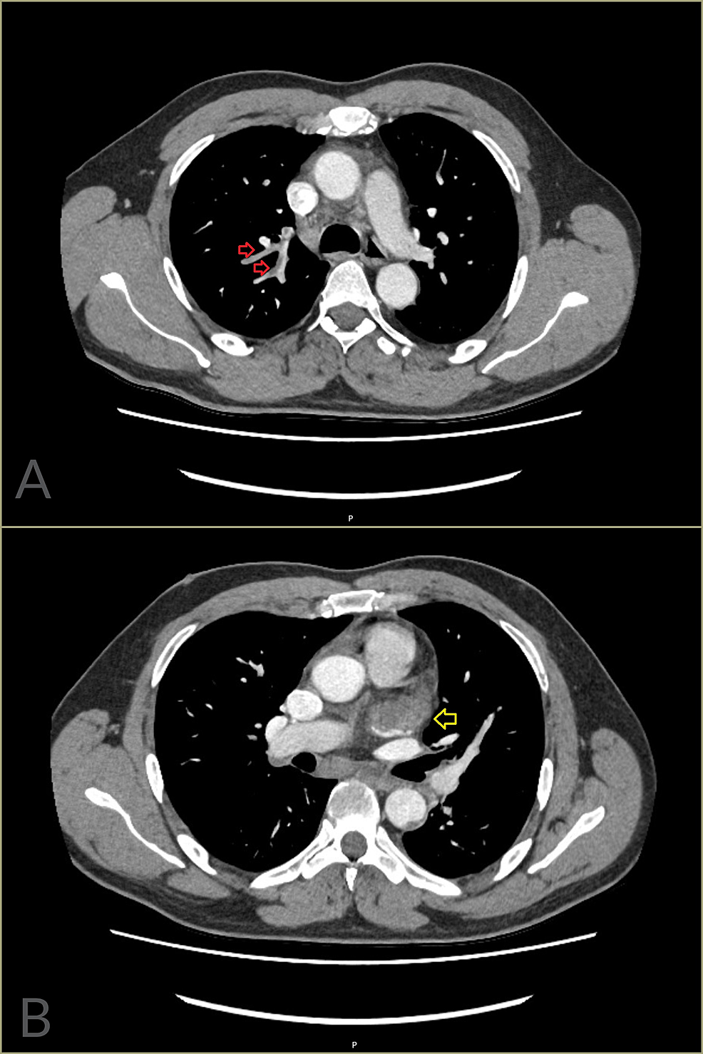 CT-of-the-chest-with-contrast-(Case-1).