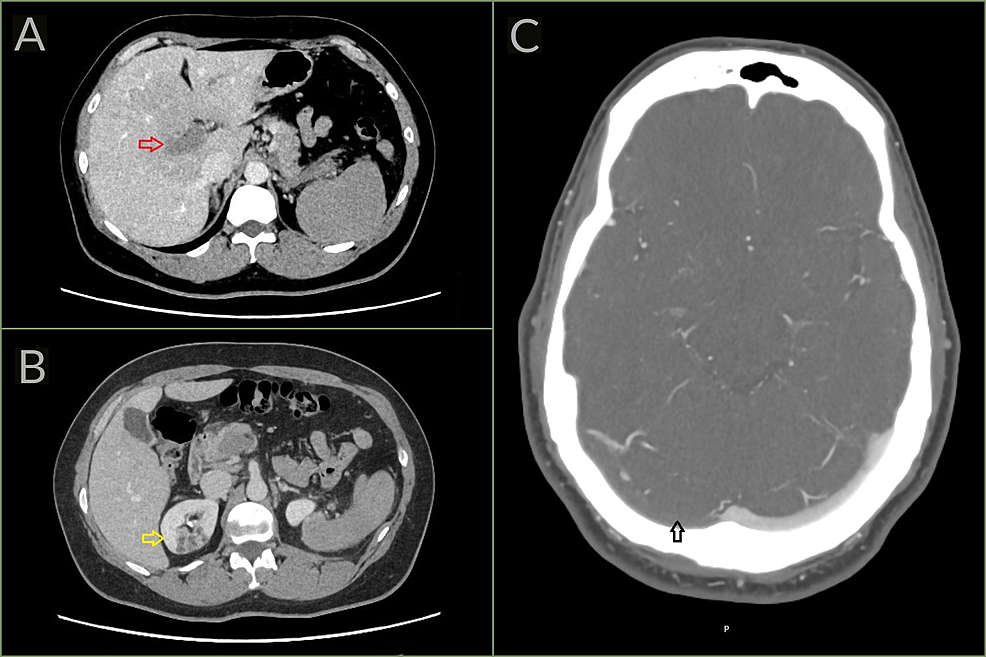 (A-and-B)-CT-of-the-abdomen-with-contrast-and-(C)-CT-of-the-head-with-venogram-(Case-2).
