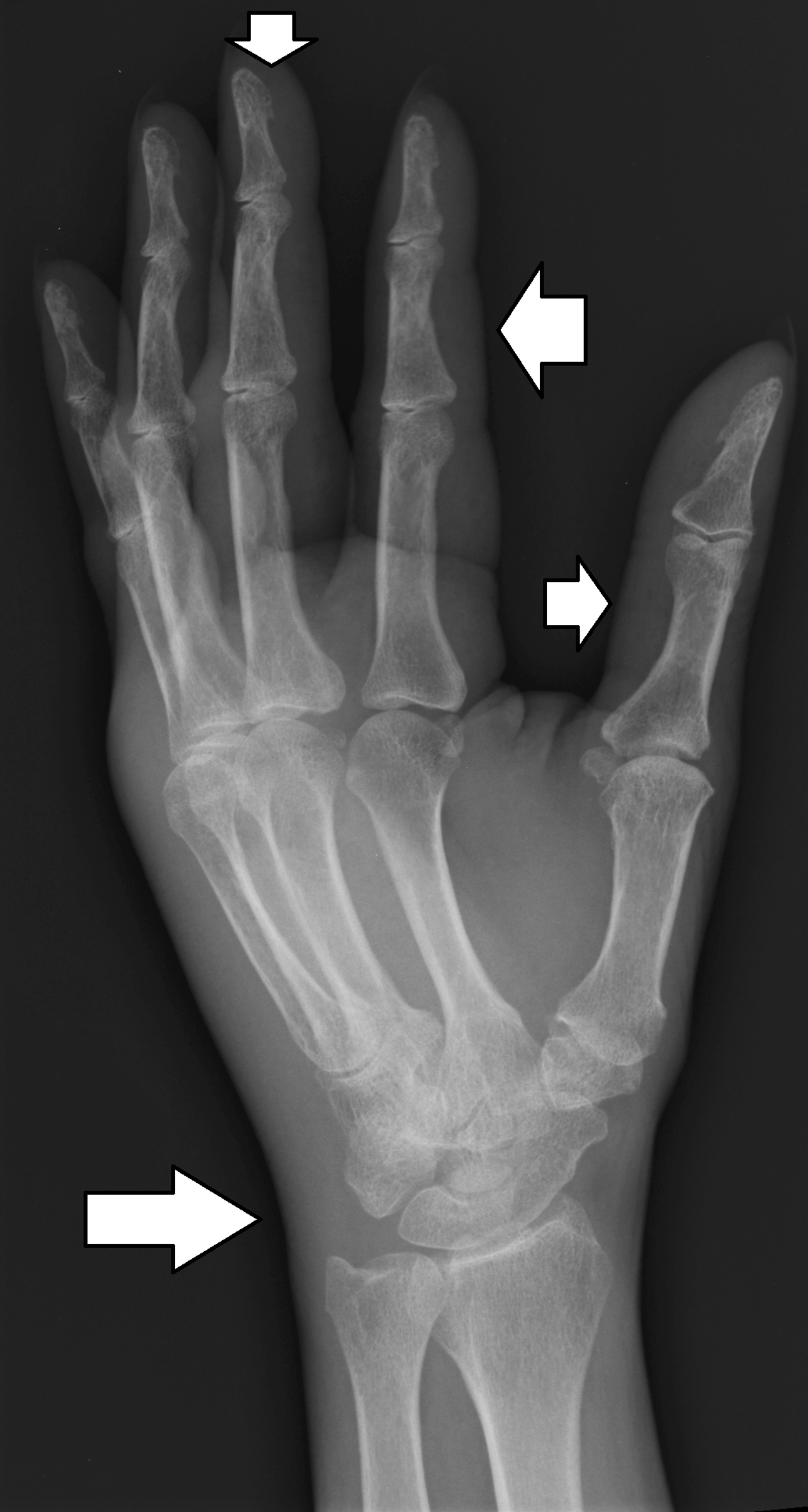 Wrist Joint X Ray