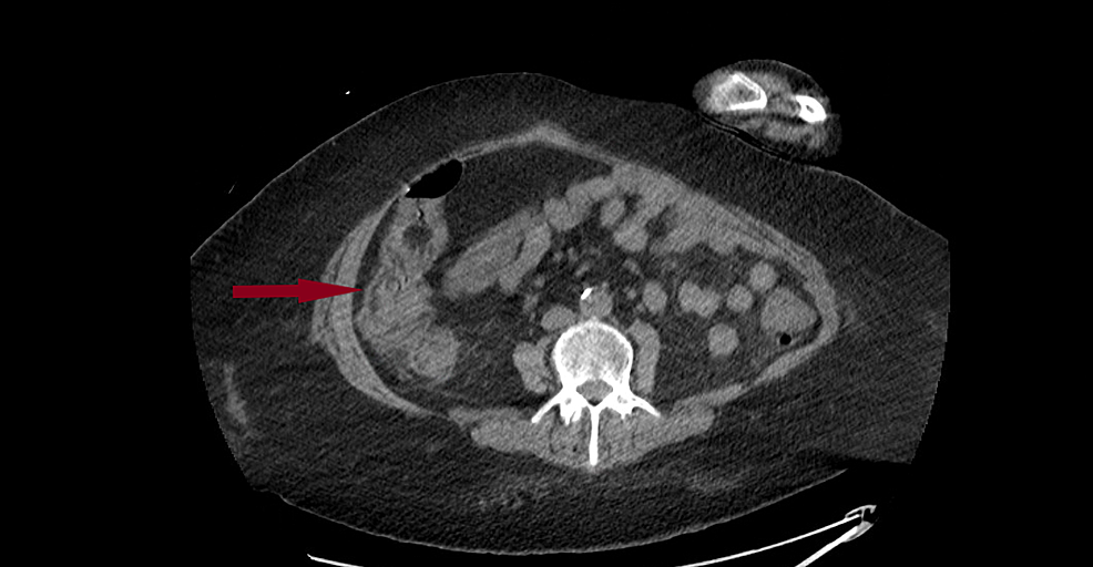 CT-abdomen-and-pelvis-without-contrast:-showing-diffuse-thickening-of-colonic-wall-with-surrounding-inflammatory-changes.-
