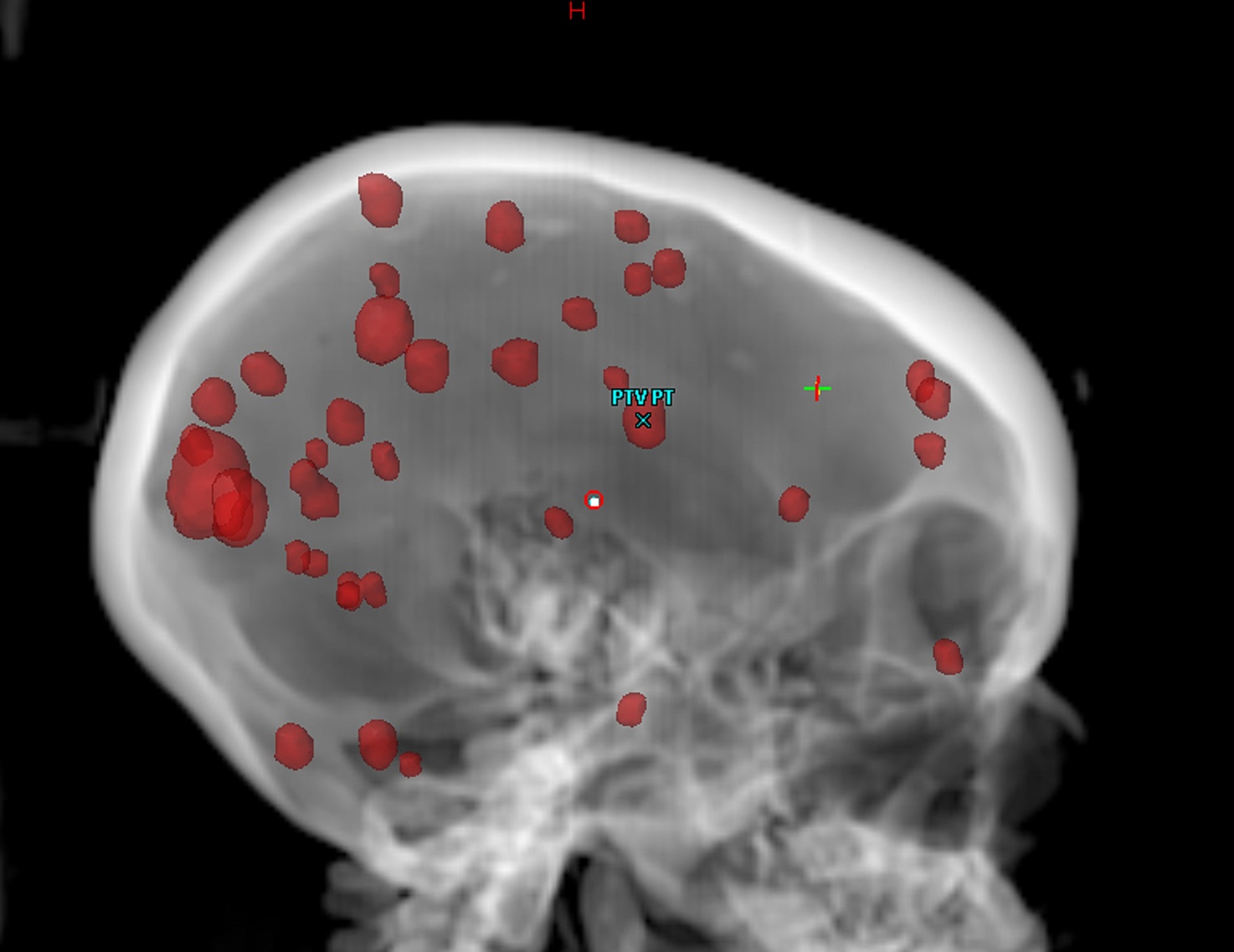 brain metastasis การ พยาบาล full