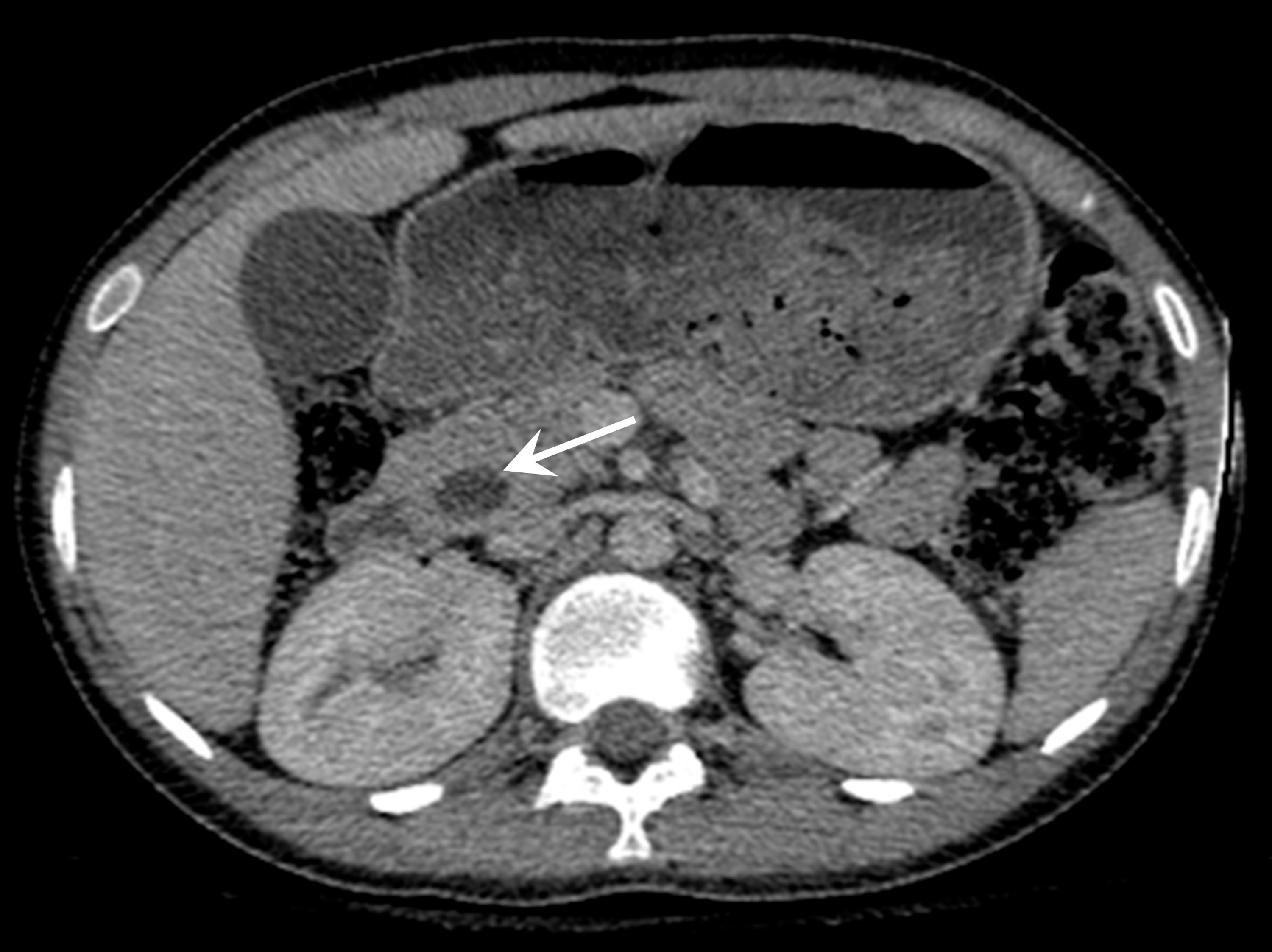 Cureus | Periampullary Carcinoma in a 13-Year-Old With Microsatellite ...