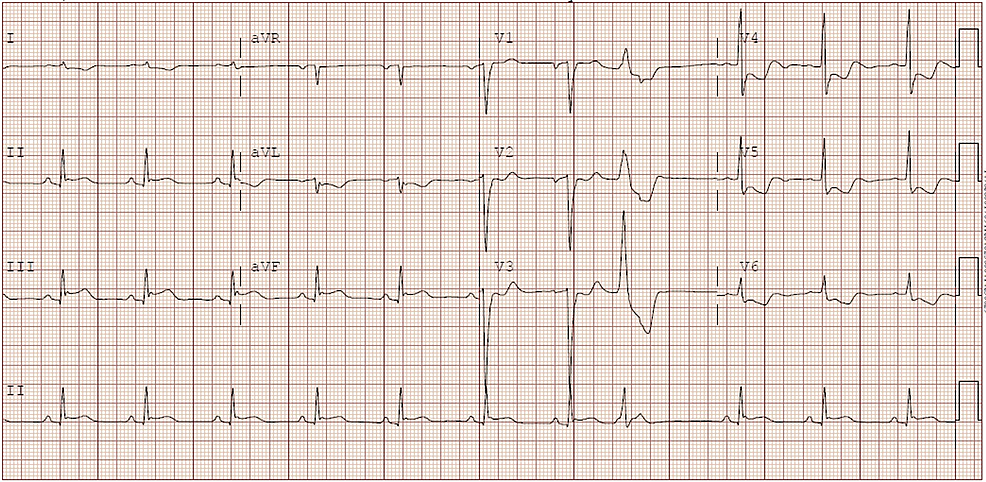 Electrocardiogram-of-the-patient-with-ST-segment-elevation-in-the-inferior-leads-(lead-II,-III,-aVF).-There-is-downsloping-ST-segment-depression-with-T-wave-inversion-in-V4-V6-with-isolated-PVC-in-lead-V3-as-well.