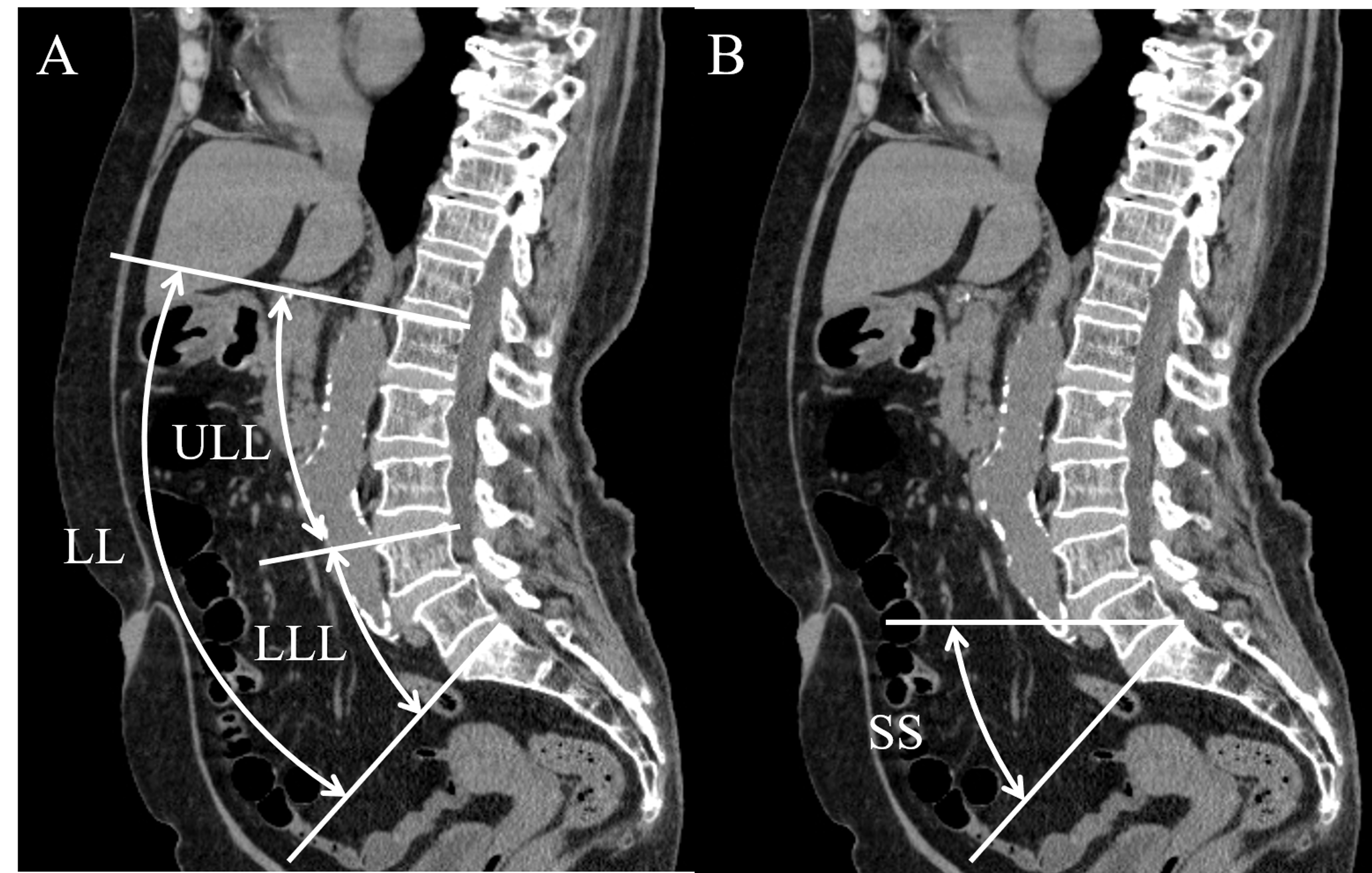 Cureus | The Quantity And Quality Of Lumbar Muscles And Lumbopelvic ...