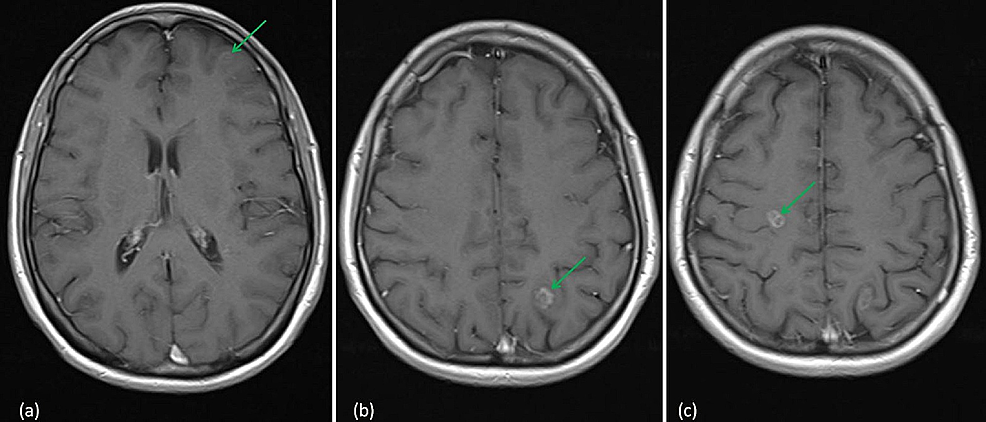 Cureus | Radiation Necrosis – A Growing Problem in a Case of Brain ...