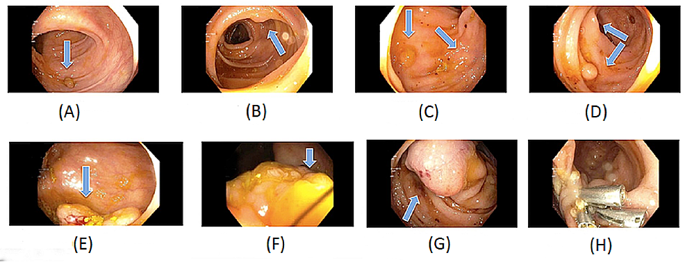 FAP patient with numerous adenomatous polyps in the colon