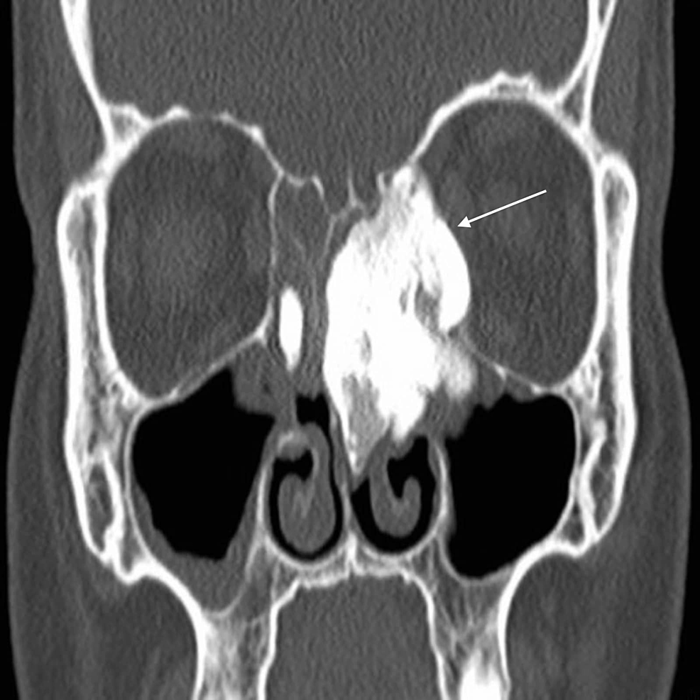Cureus A Case Of Giant Ethmoid Sinus Osteoma 4436