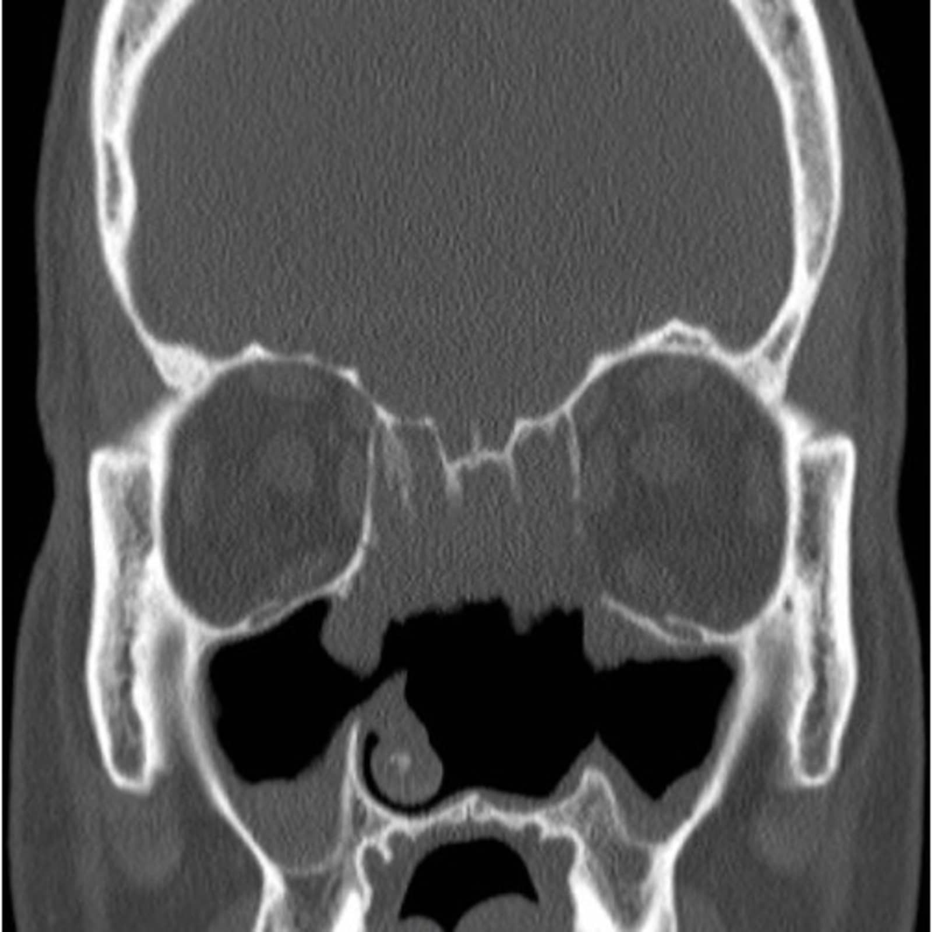 Ethmoid Sinus Ct Scan