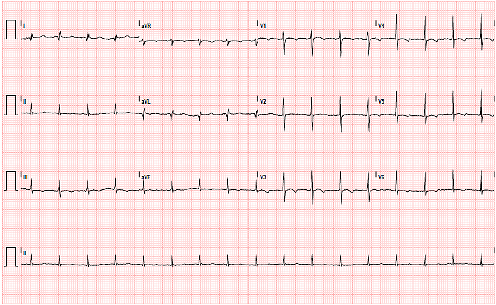 Electrocardiogram-(EKG)-showing-supraventricular-tachycardia-with-nonspecific-ST-segment-and-T-wave-changes