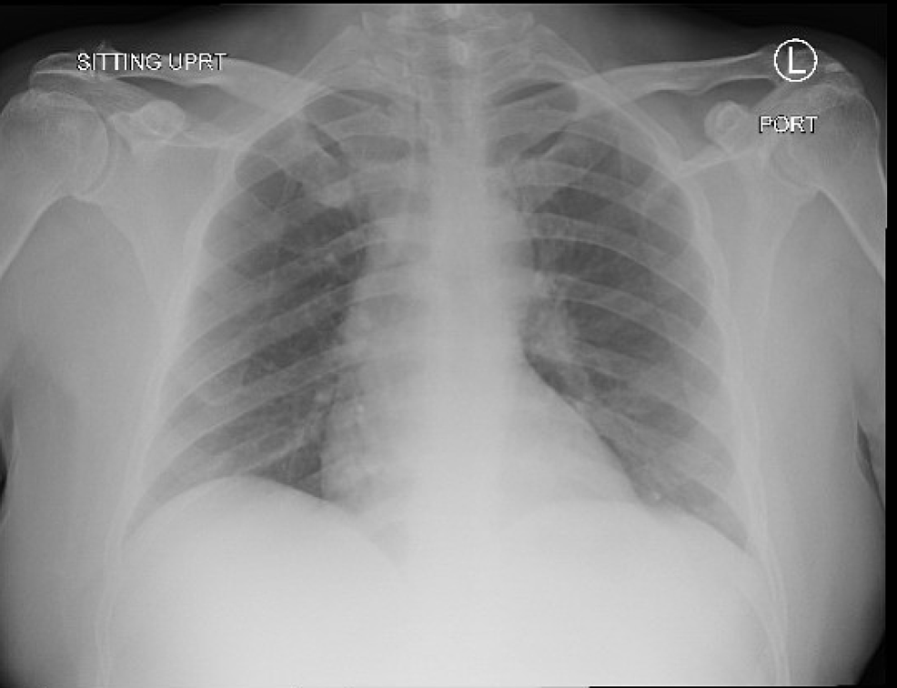 Initial-chest-radiograph-showing-no-focal-evidence-of-airspace-disease