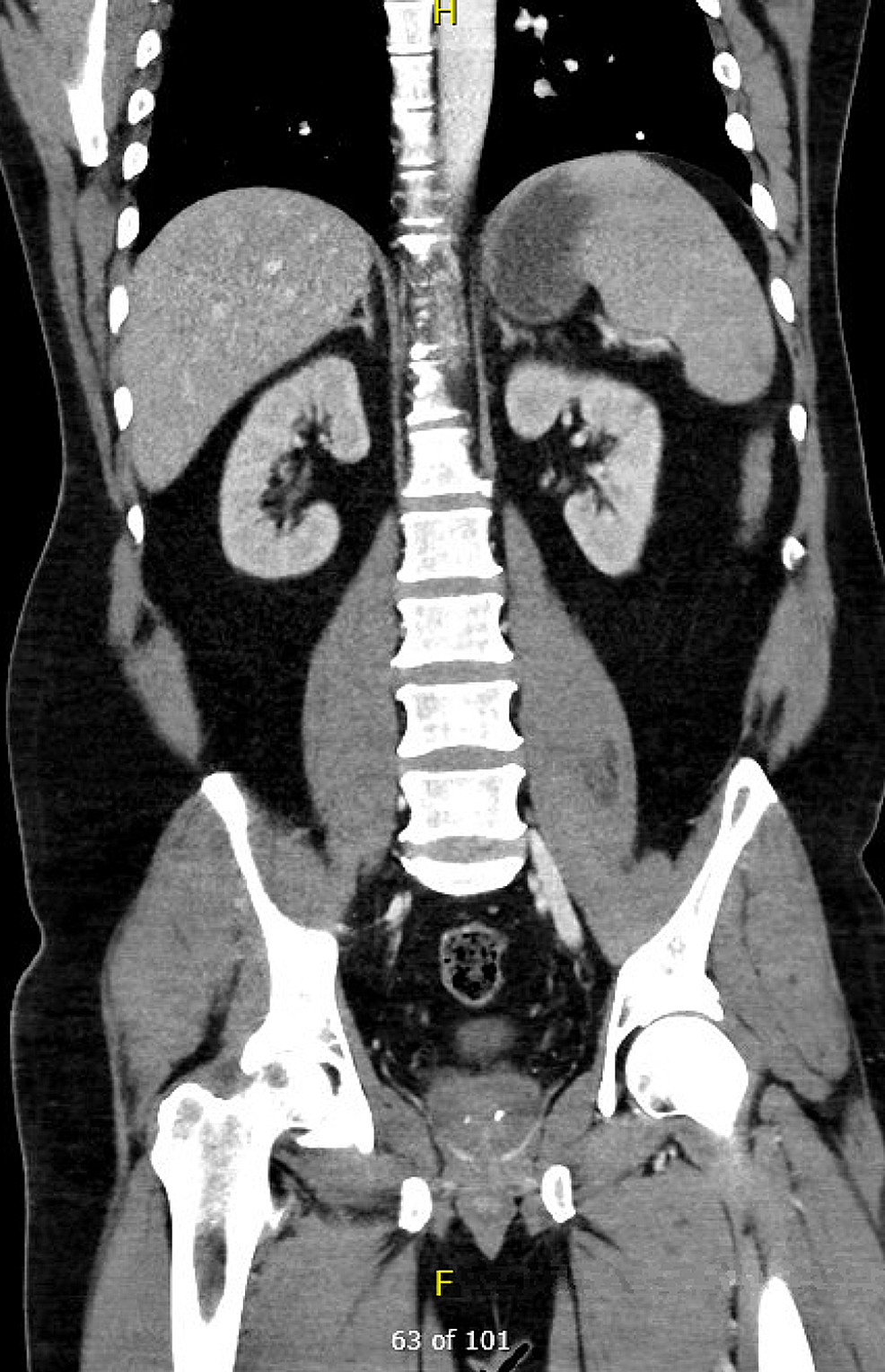 CT-abdomen-and-pelvis-showing-mild-splenomegaly