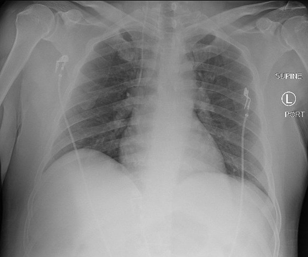 Repeat-chest-x-ray-showed-bibasilar-opacities-worse-throughout-the-right-lobes
