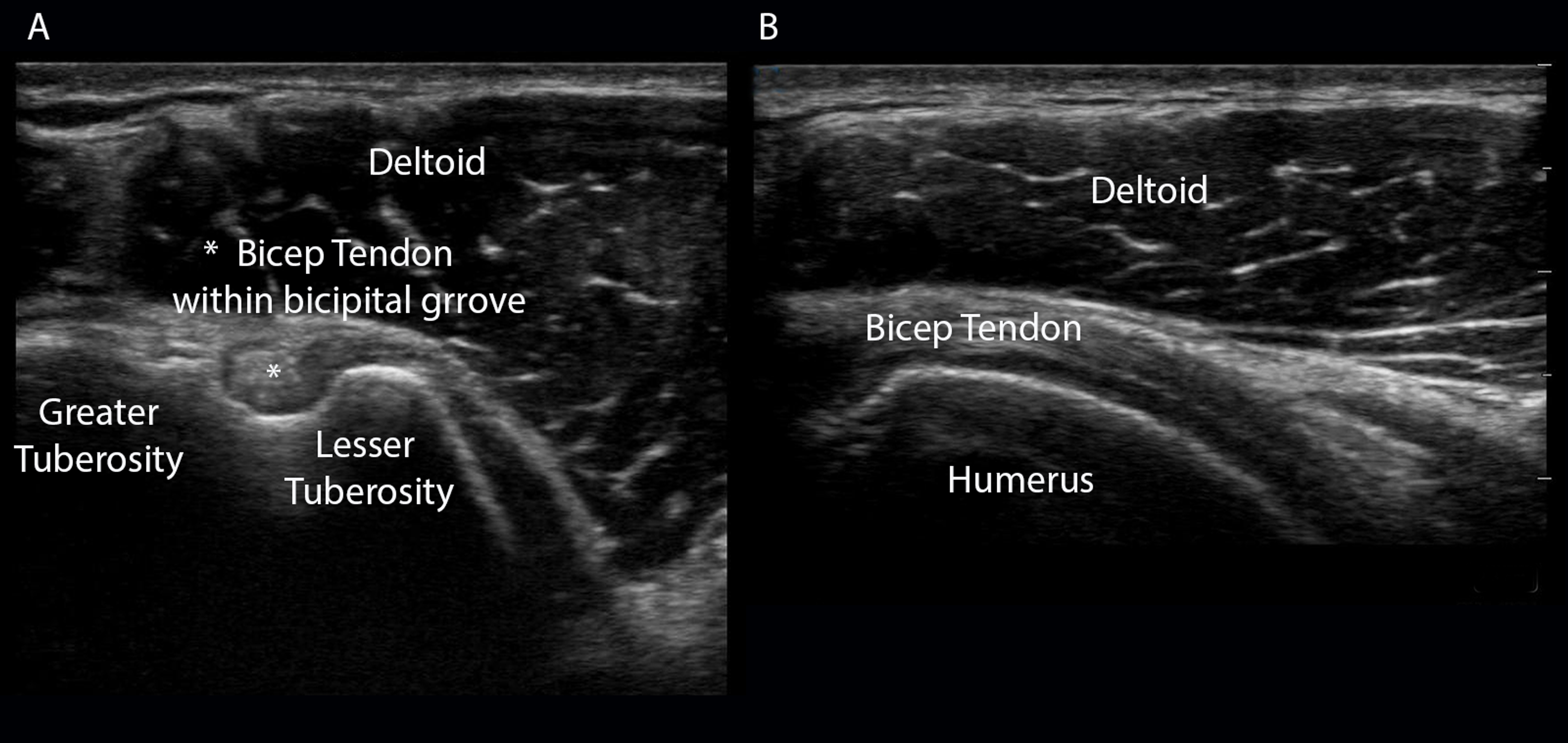 Cureus A Stepwise Guide to Performing Shoulder Ultrasound The