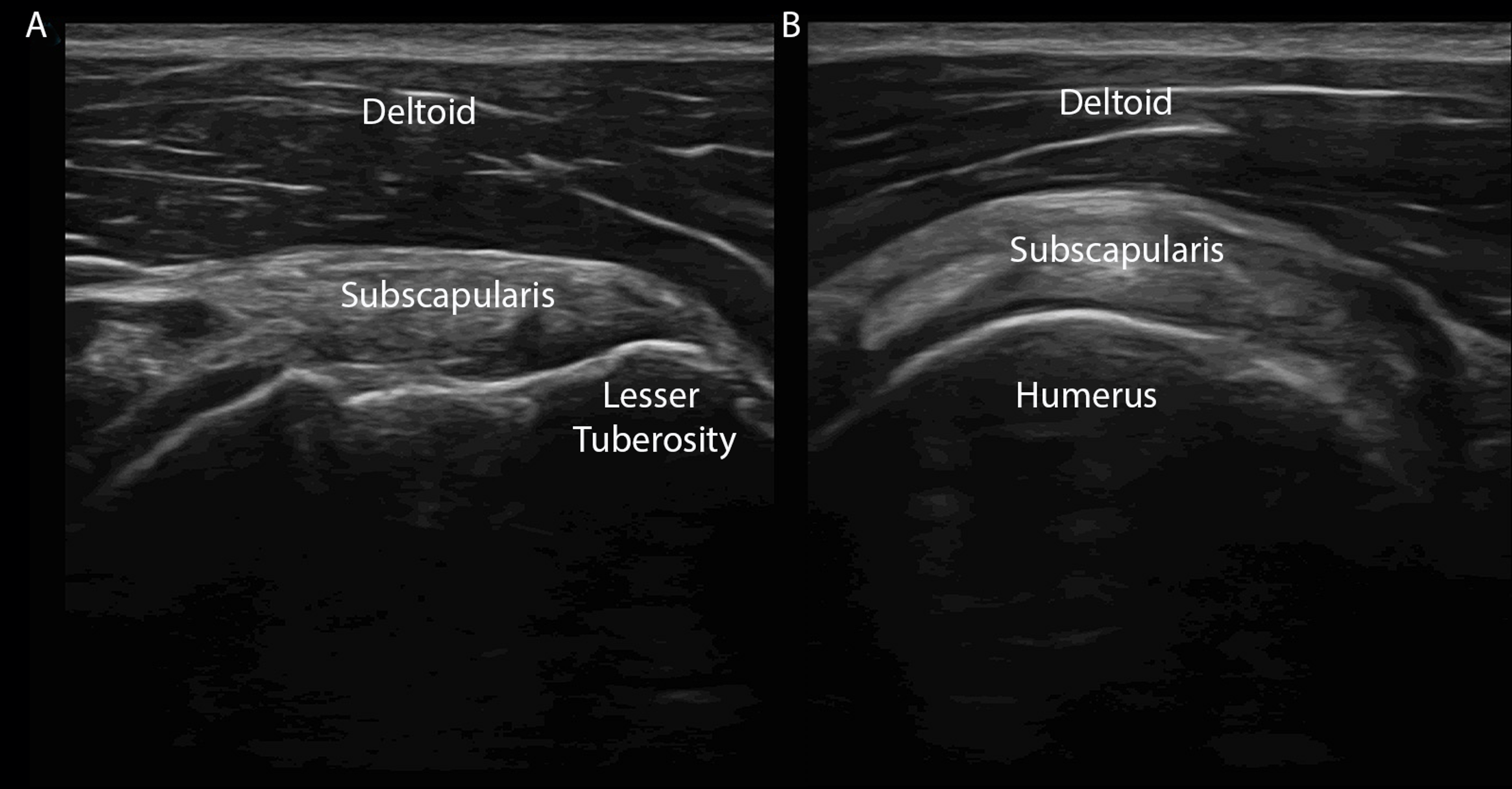 Cureus A Stepwise Guide to Performing Shoulder Ultrasound The