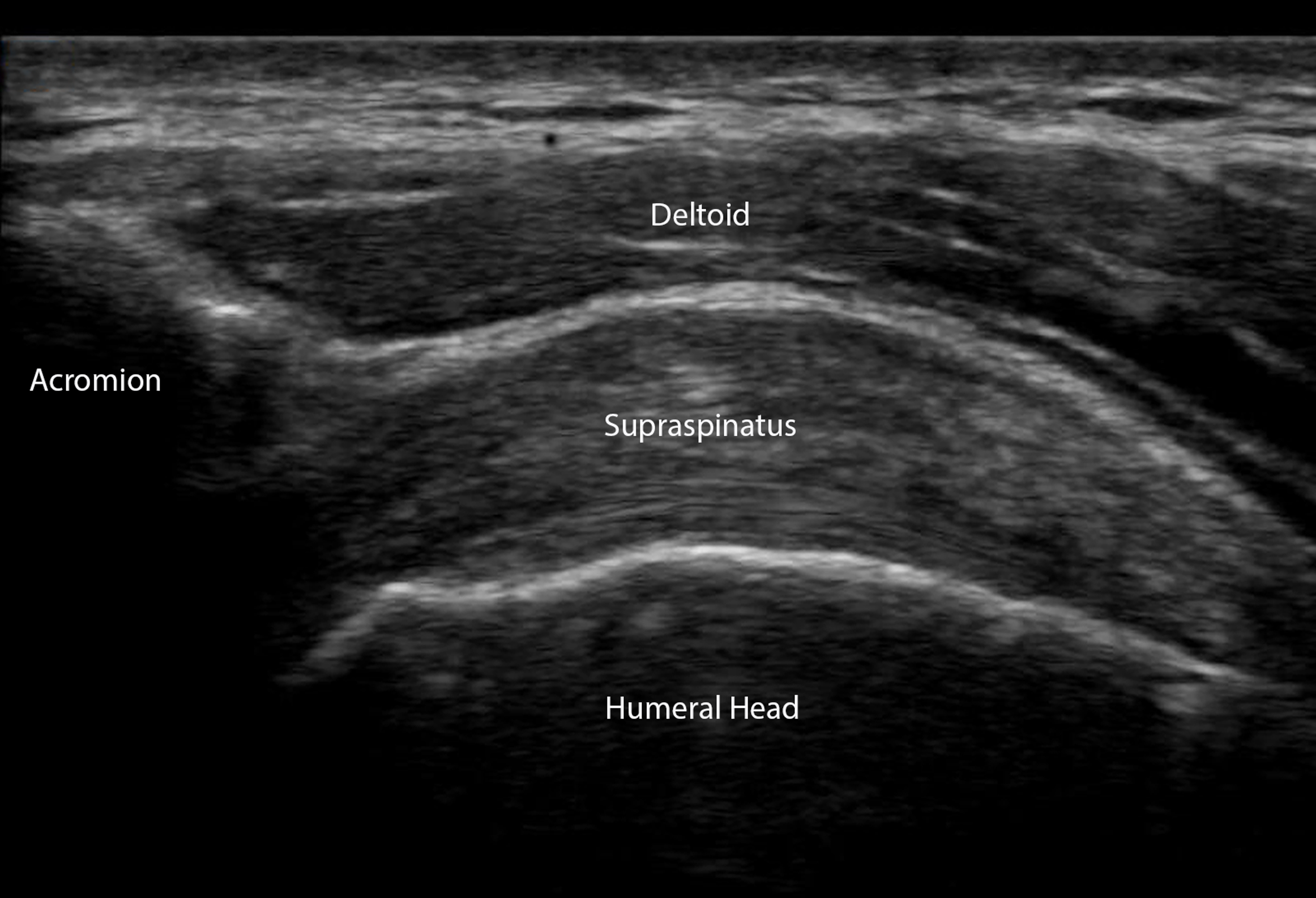 Cureus | A Stepwise Guide to Performing Shoulder Ultrasound: The Acromio-Clavicular Joint, Subscapularis, Supraspinatus Protocol | Article