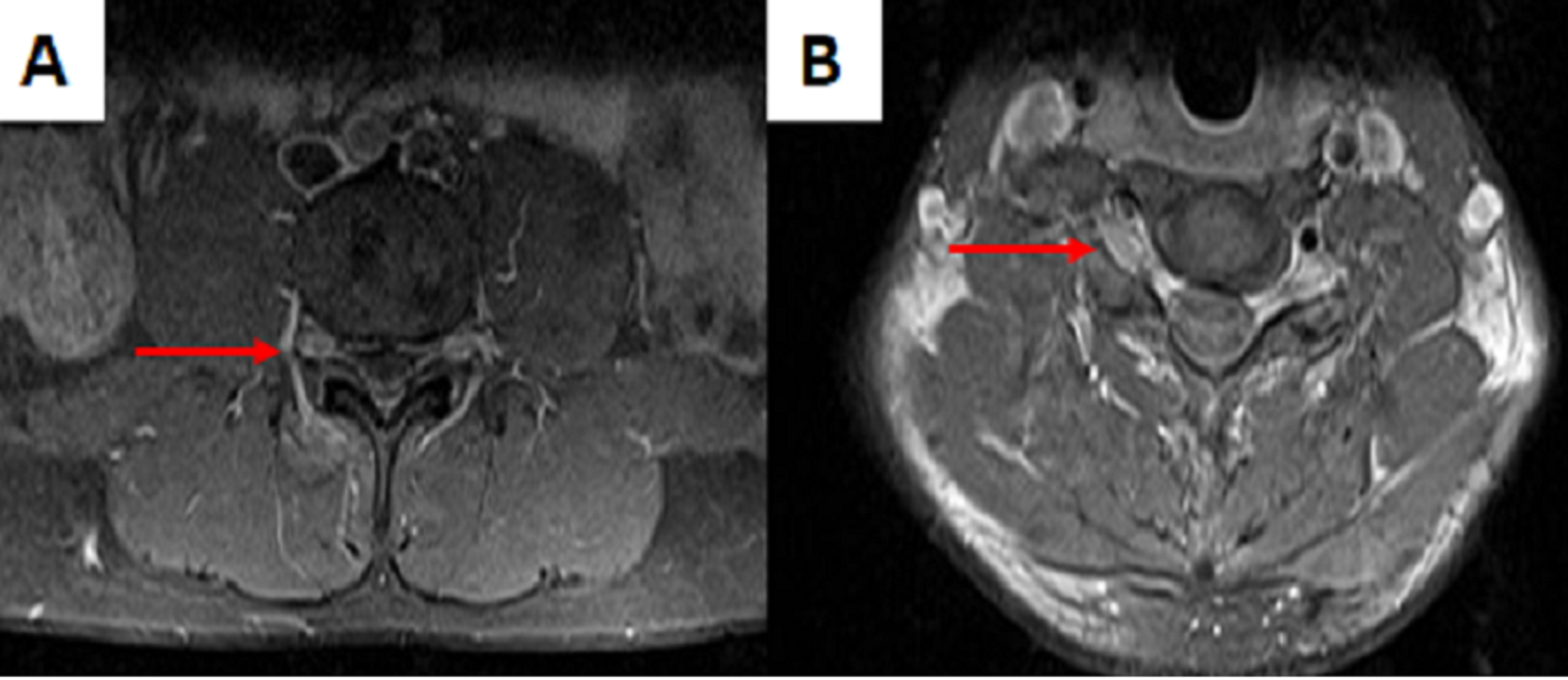 Cureus Chronic Immune Sensory PolyradiculoneuropathyPlus With