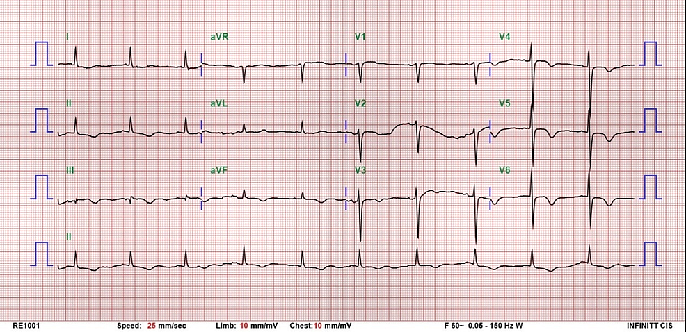 Twelve-lead-electrocardiogram-at-emergency-department
