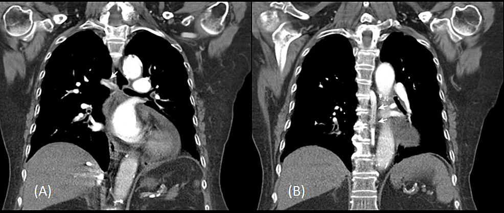 The-post-contrast-enhanced-chest-CT-in-coronal-reformation-showed-partial-filling-defect-in-the-horizontal-(A)-and-vertical-(B)-portions-of-the-azygos-vein,-indicating-azygos-vein-thrombosis-(white-arrows)