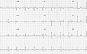 Cureus | Recurrent Episodes of Paroxysmal Supraventricular Tachycardia ...