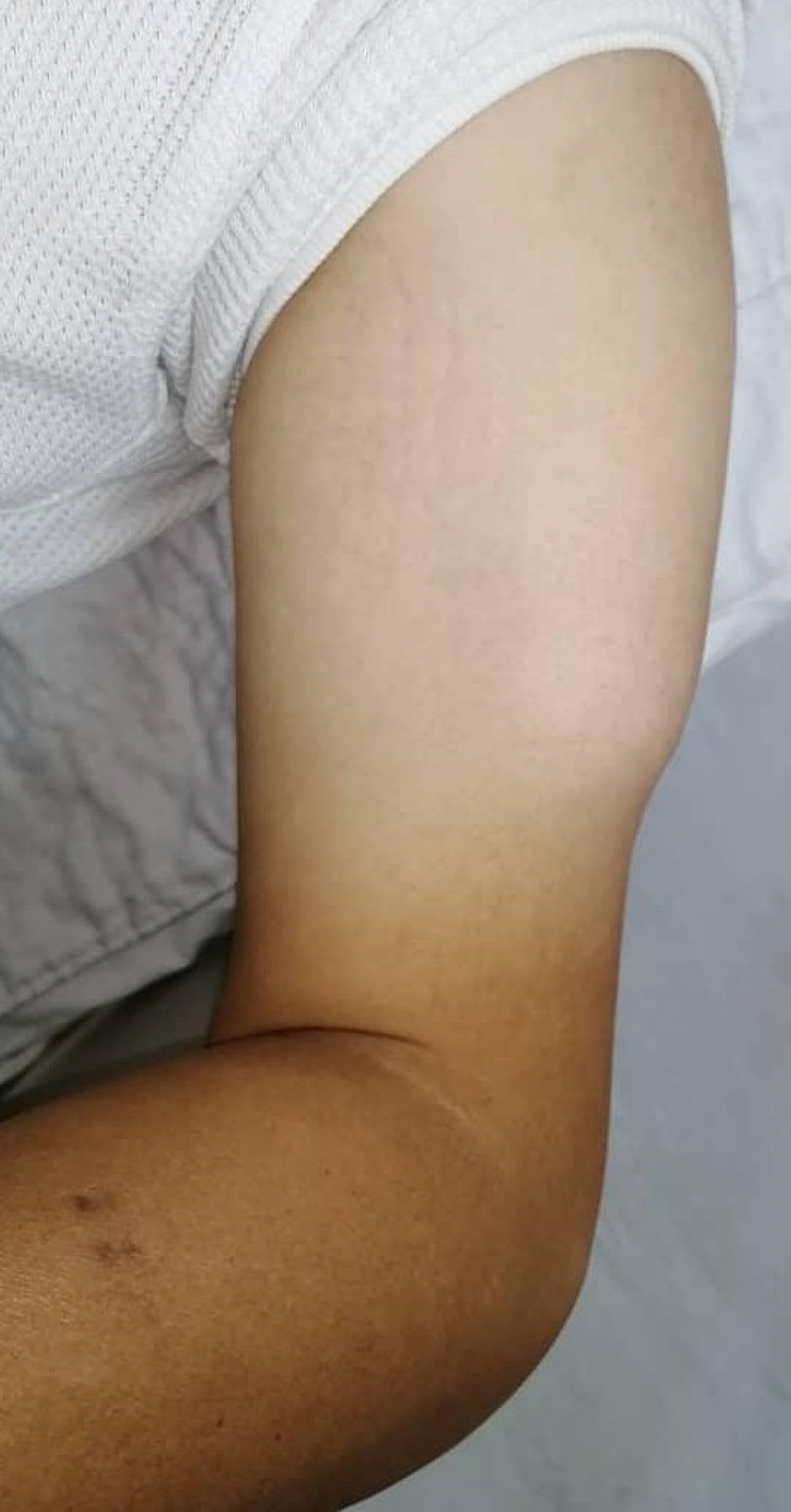 Necrotizing Soft Tissue Infection of Left Shoulder and Upper Limb Following Intravenous Injection of Non-steroidal Anti-inflammatory Drug