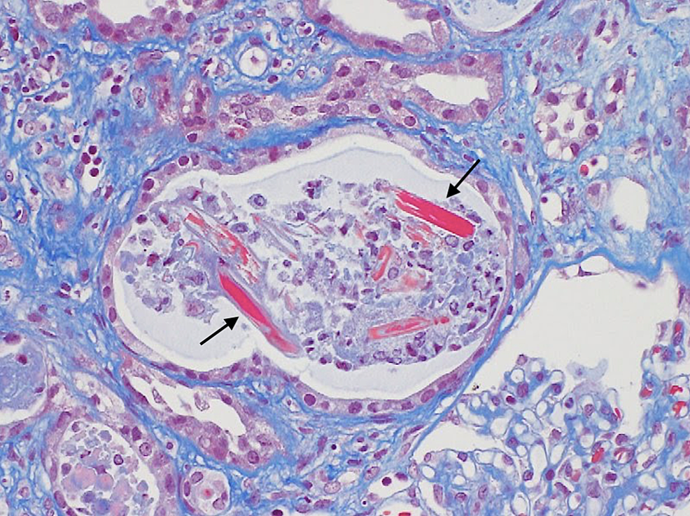 Masson-staining-for-renal-biopsy