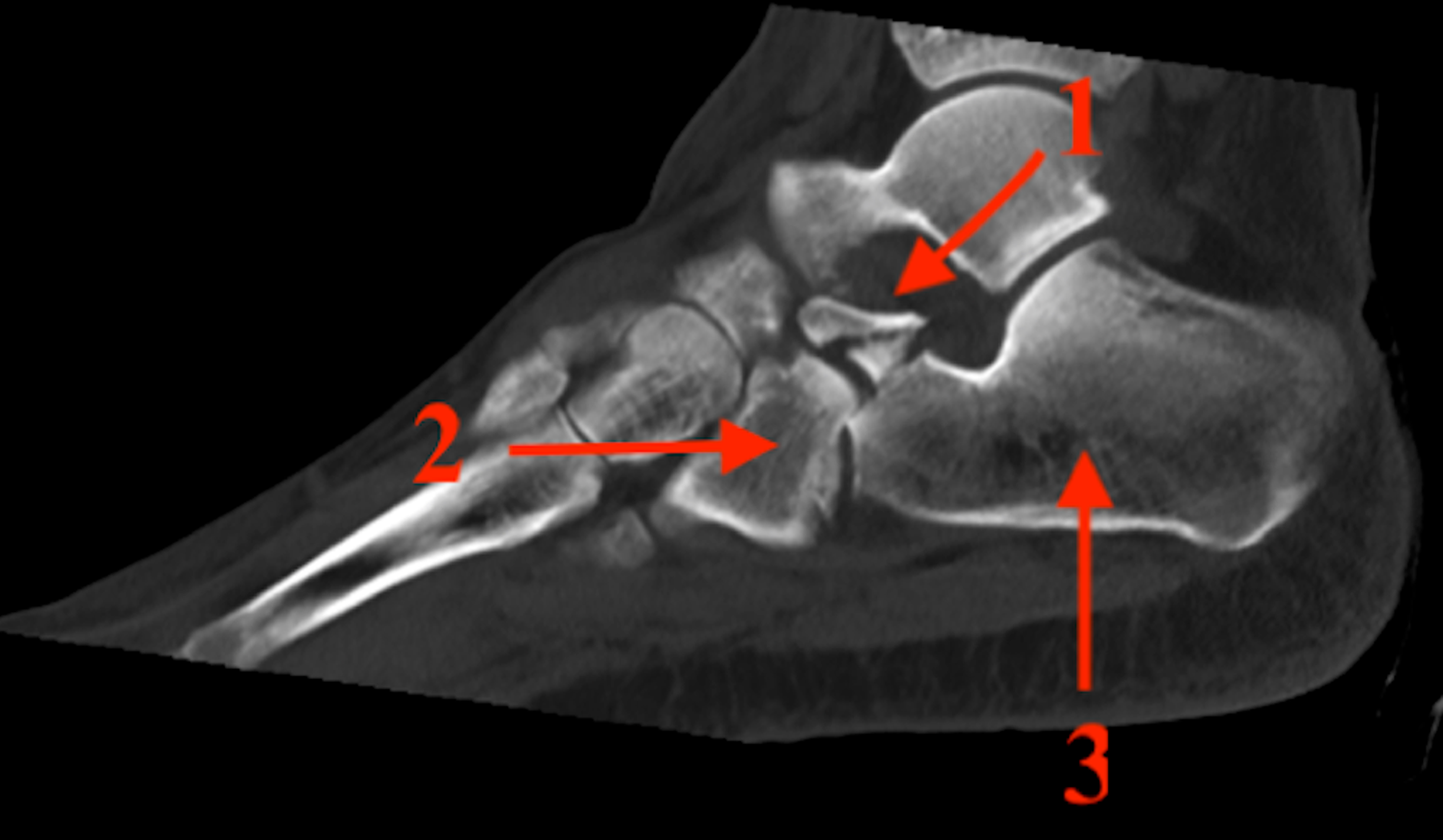 Cureus Open Reduction and Internal Fixation of a Calcaneal Anterior