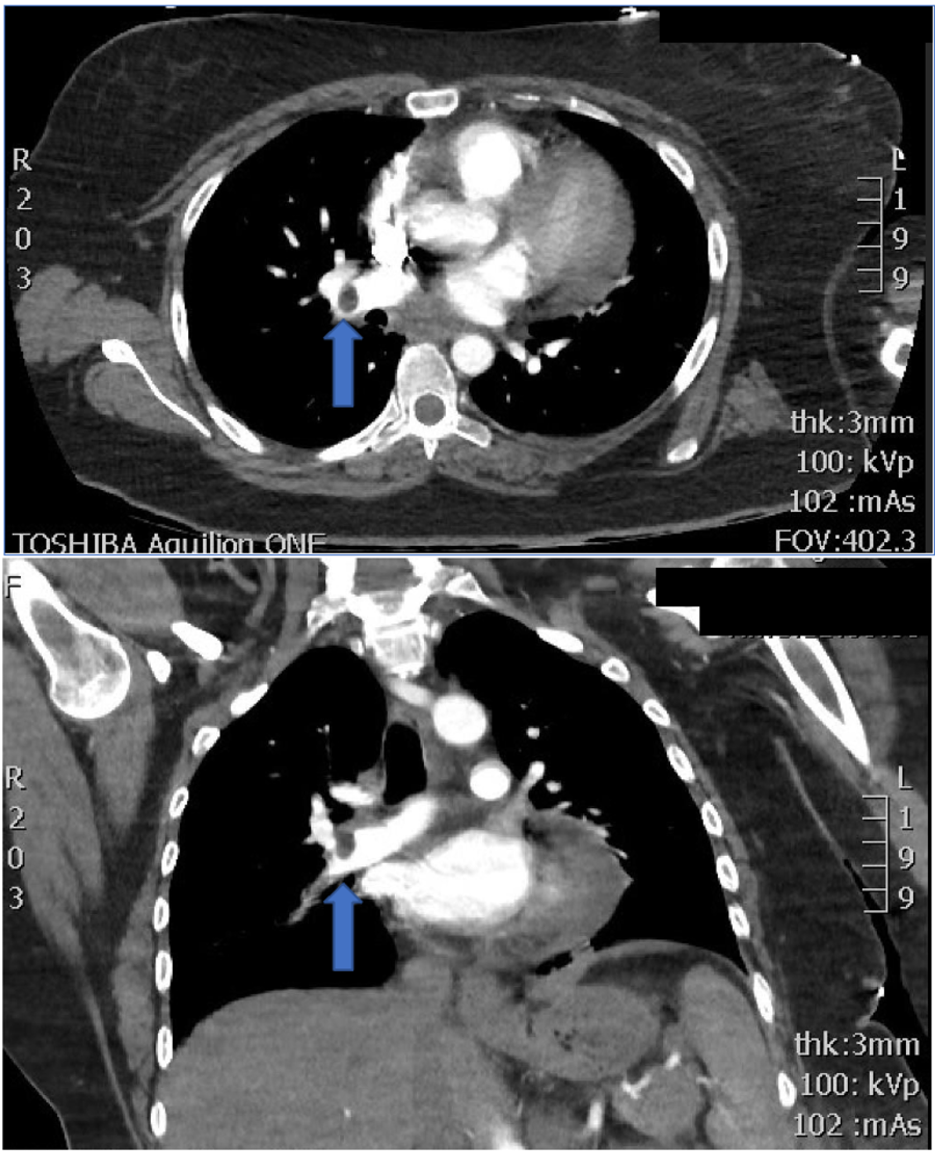 cureus emphysematous pyelonephritis complicated by necrotising fasciitis and massive pulmonary embolus a regional australian experience