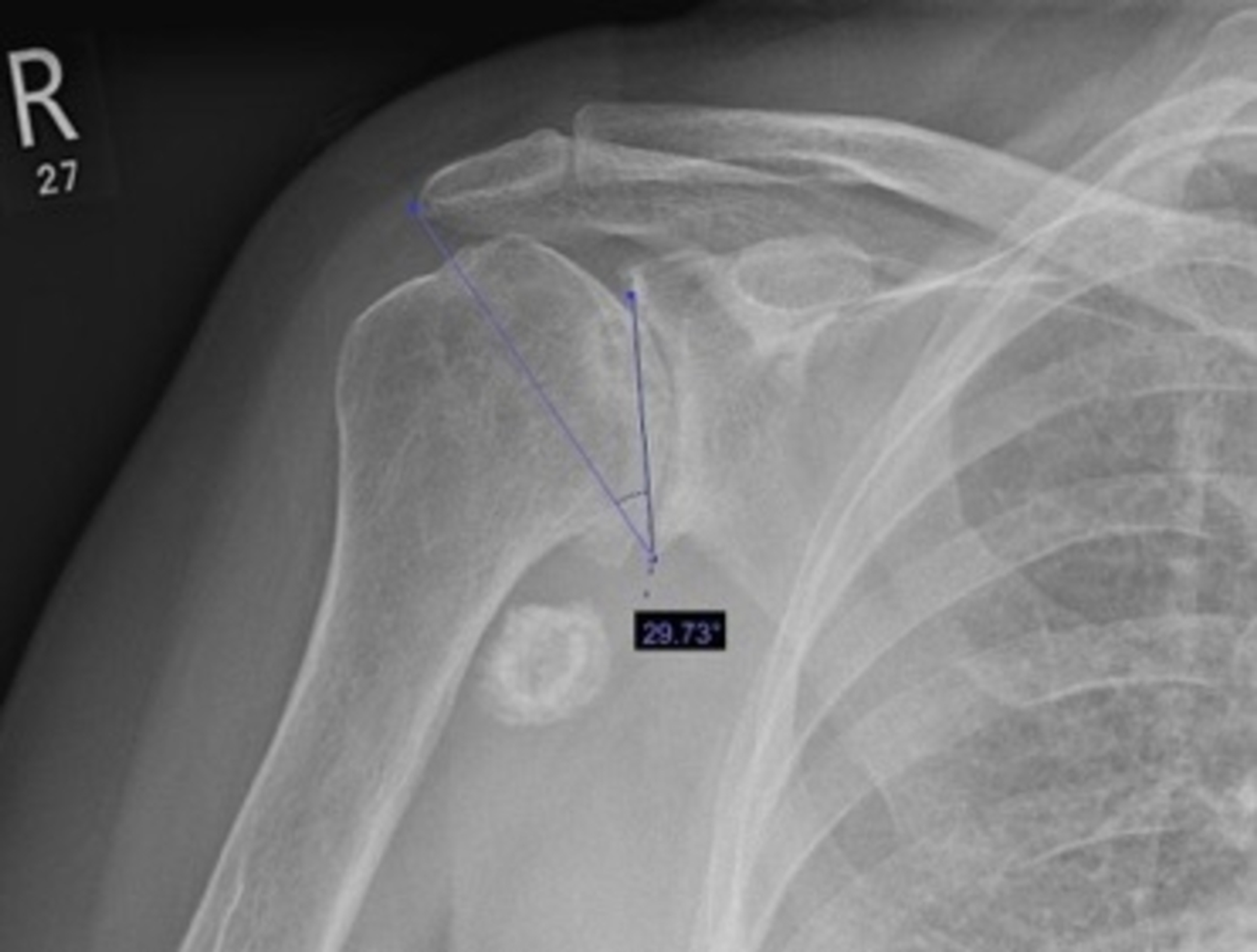 Cureus | The Influence of Critical Shoulder Angle in Secondary Rotator ...