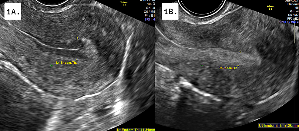 Transvaginal-Ultrasound-of-Endometrial-Lining