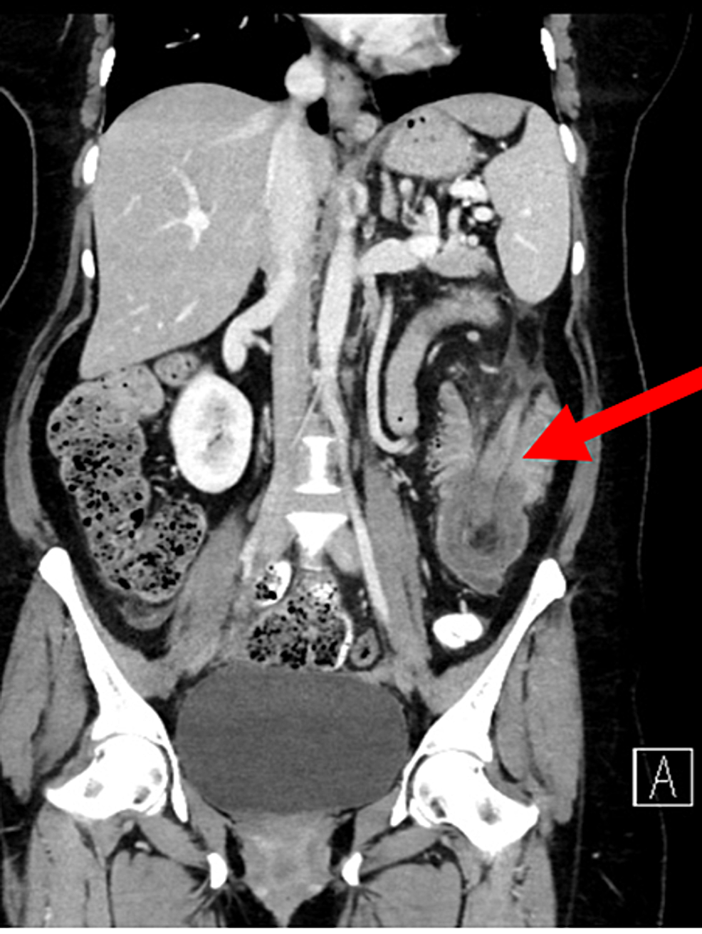 cureus-colonic-lipoma-as-a-leading-cause-of-intussusception-resulting