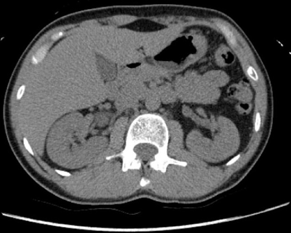 Differential Diagnosis of Flank Pain, PDF, Kidney