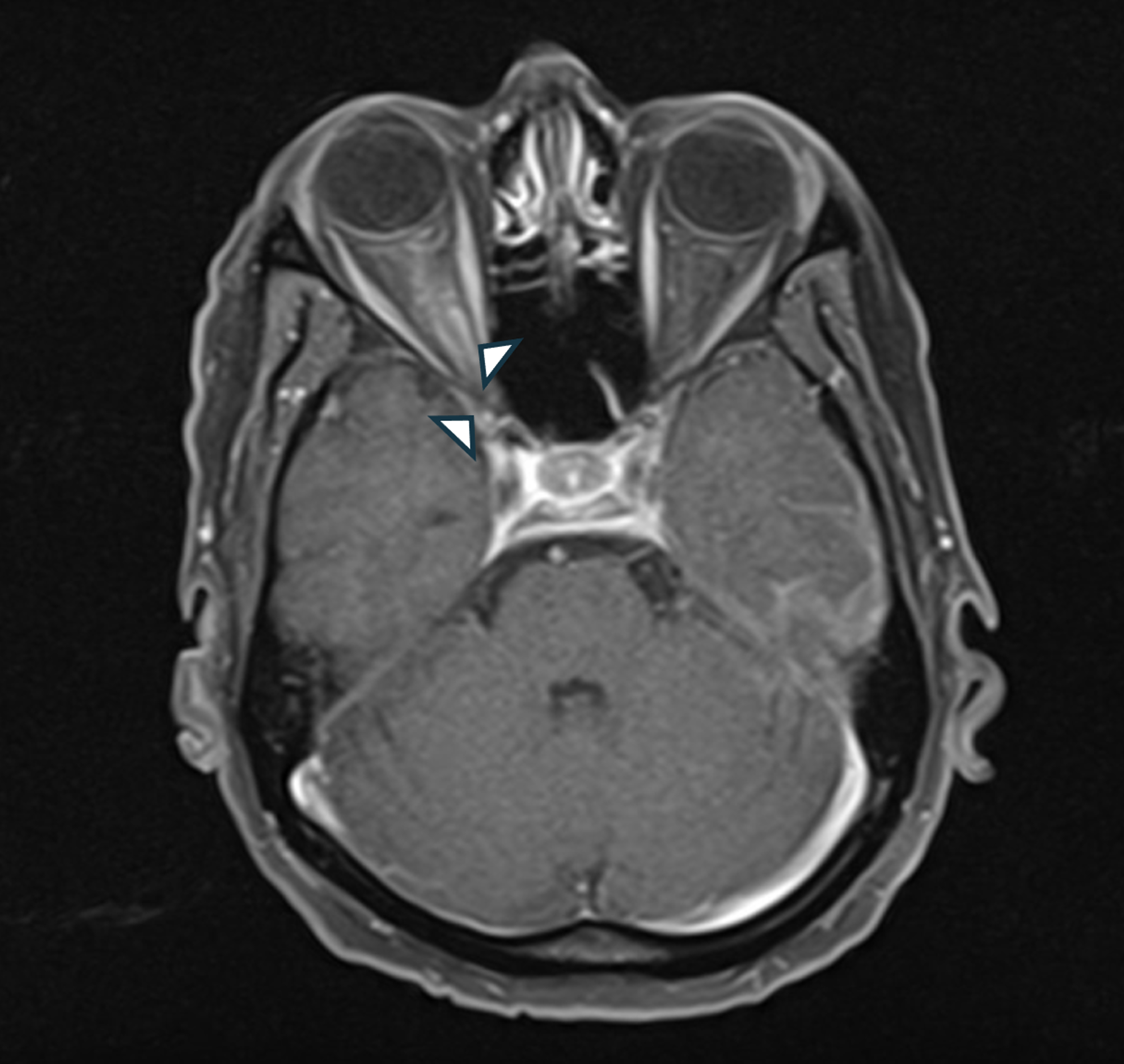 Cureus | Optic Nerve Infiltration in Systemic Lymphoma in an HIV Patient