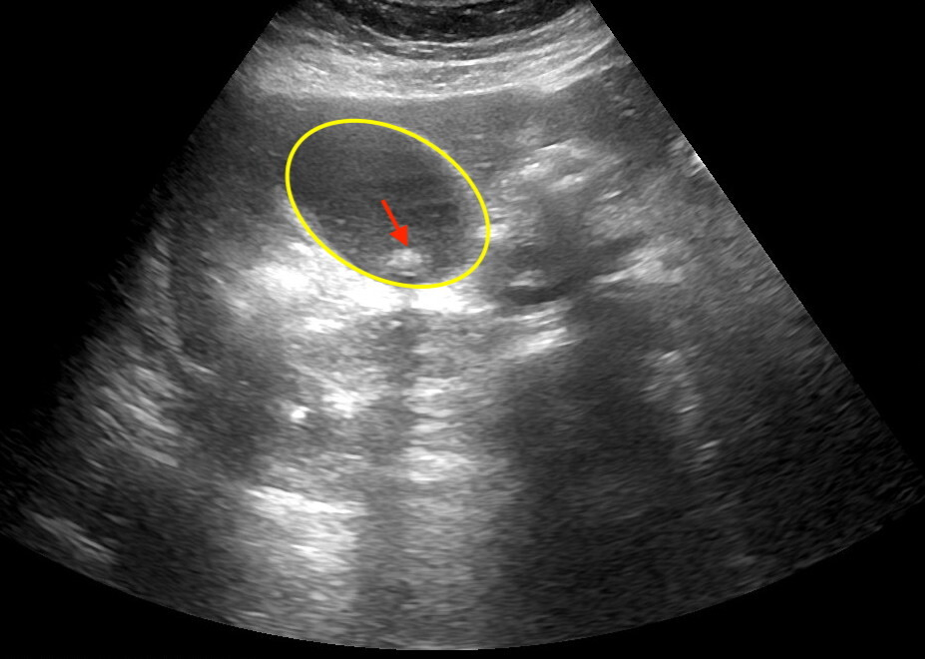Gallbladder Hydrops Ultrasound