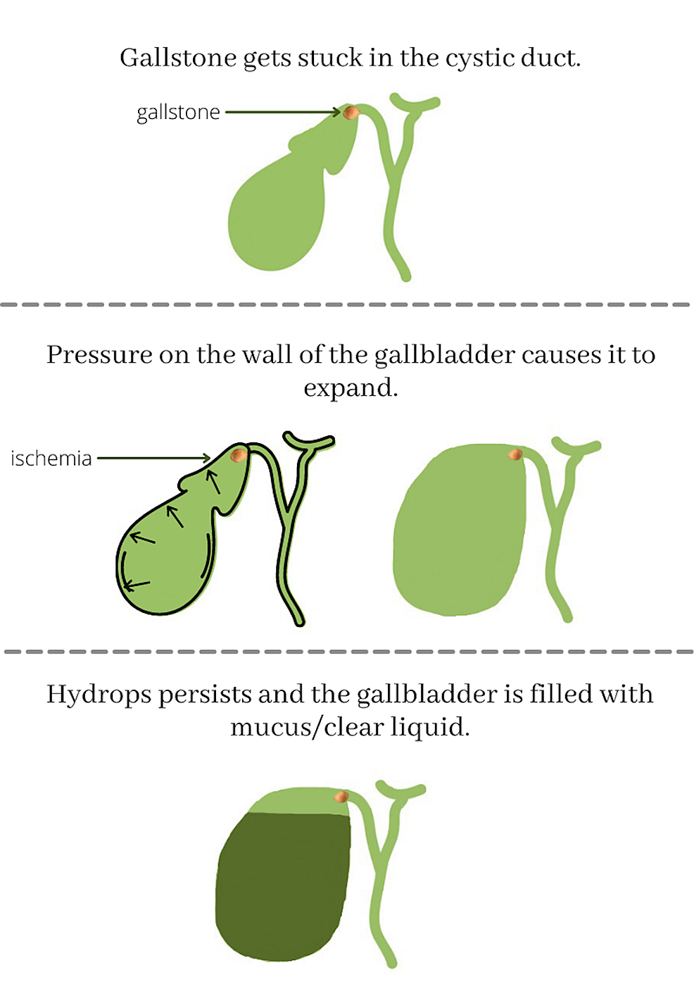 Cureus | Gallbladder Hydrops